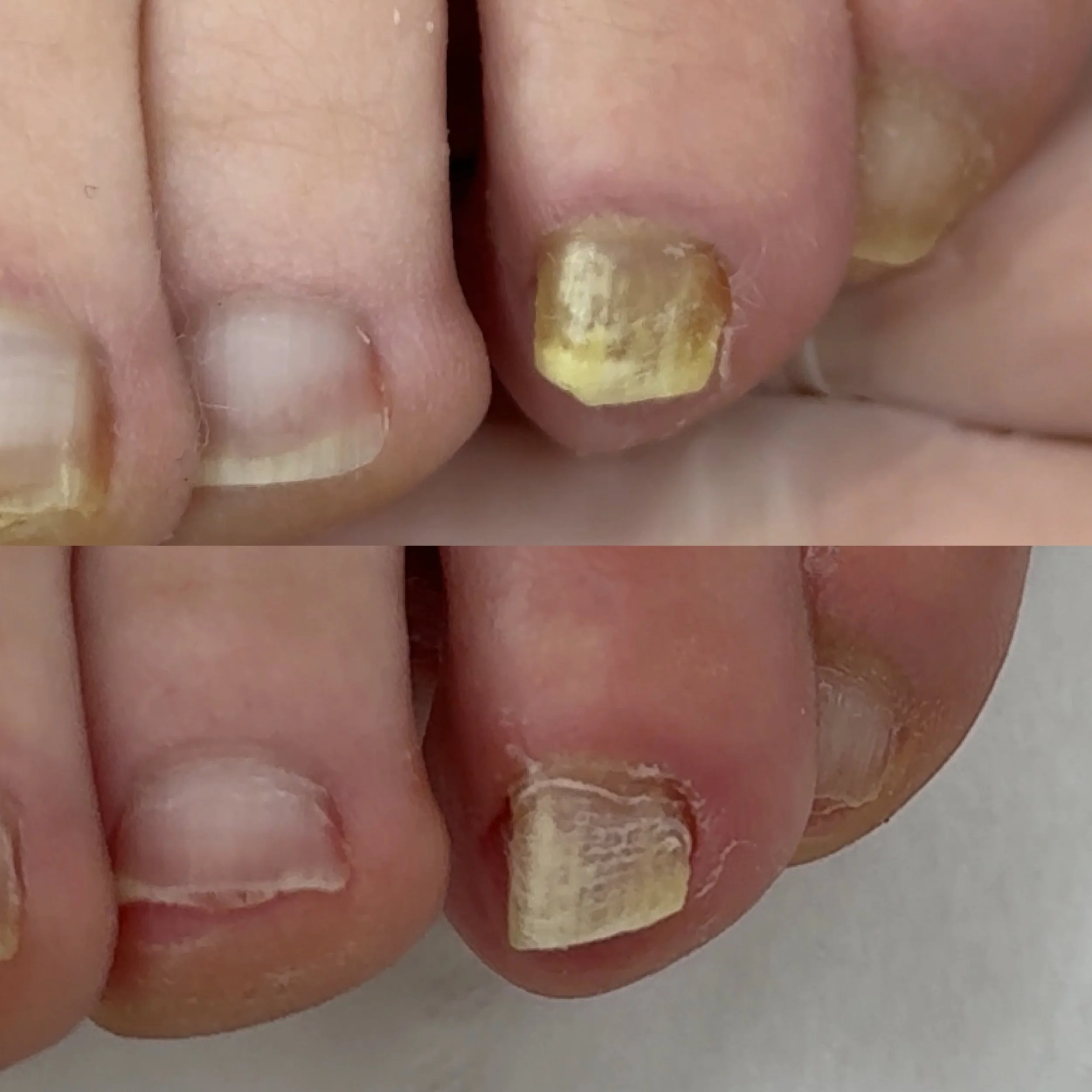 Fungal nail laser treatment being carried out at Seven Skin