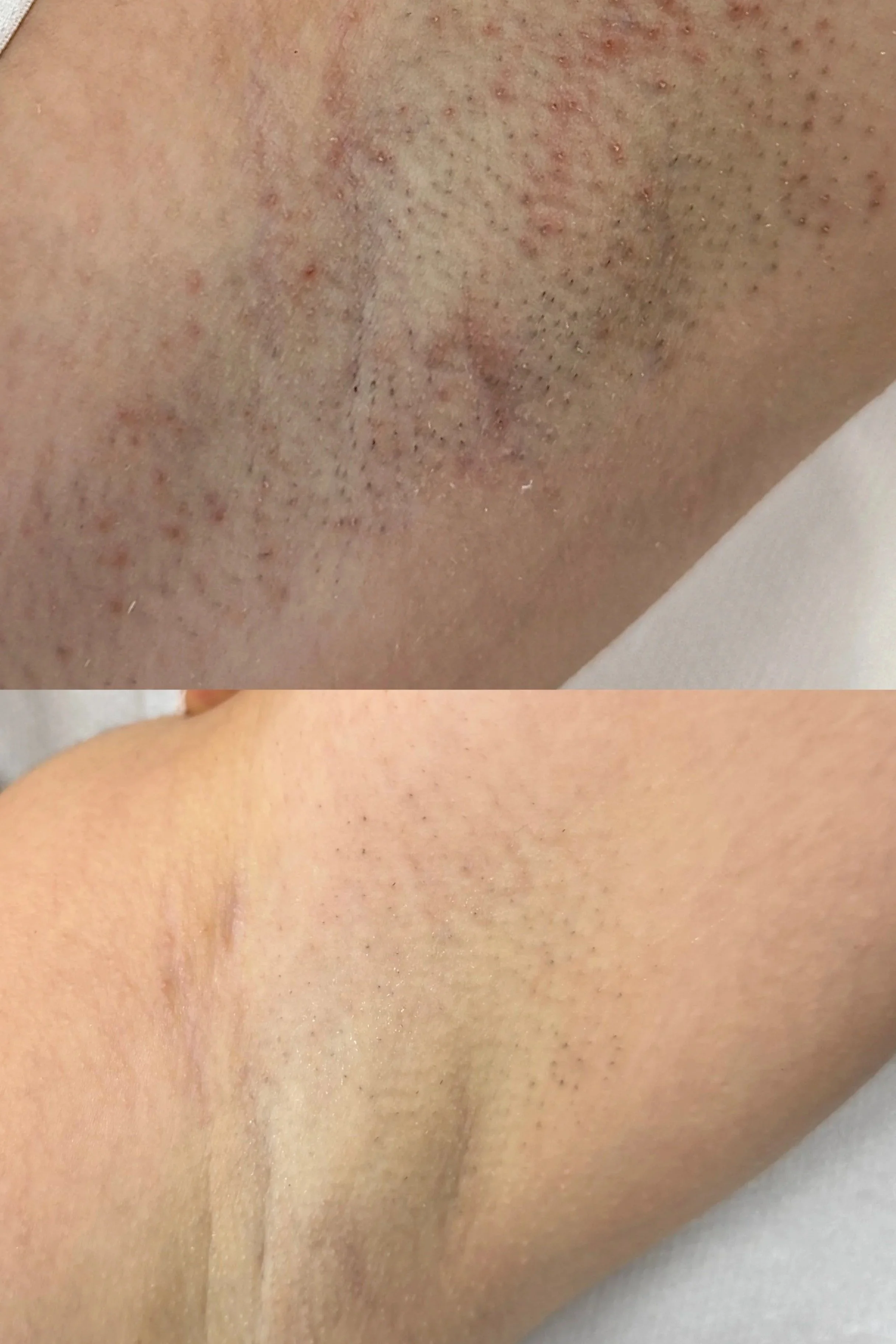 Laser hair removal treatment progress at Seven Skin