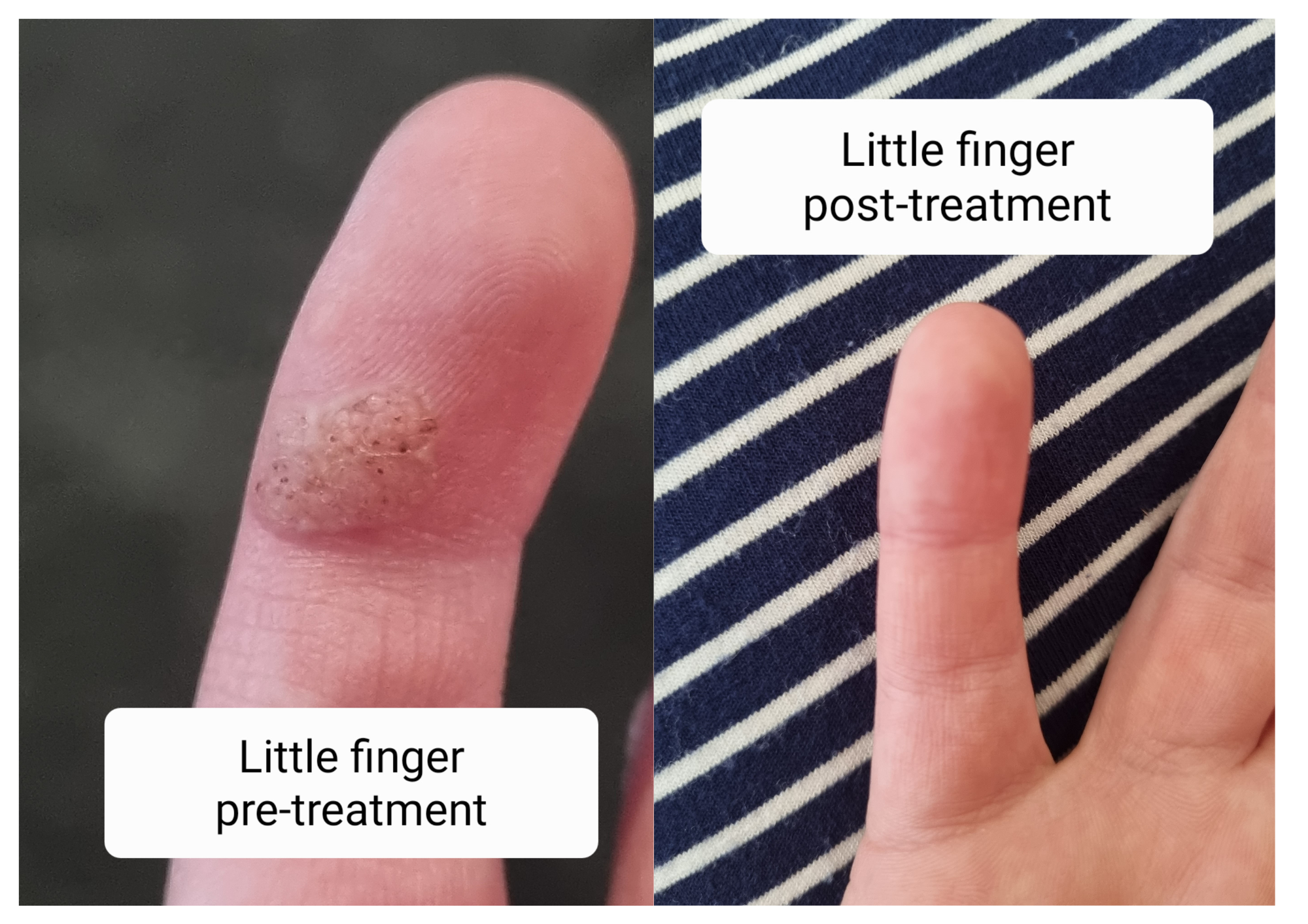 Before and after photos of a wart on the little finger, cleared after Swift treatment