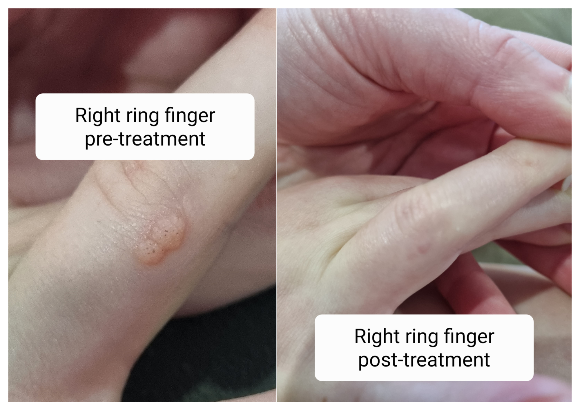 Before and after photos of a wart on the right ring finger, cleared after Swift treatment