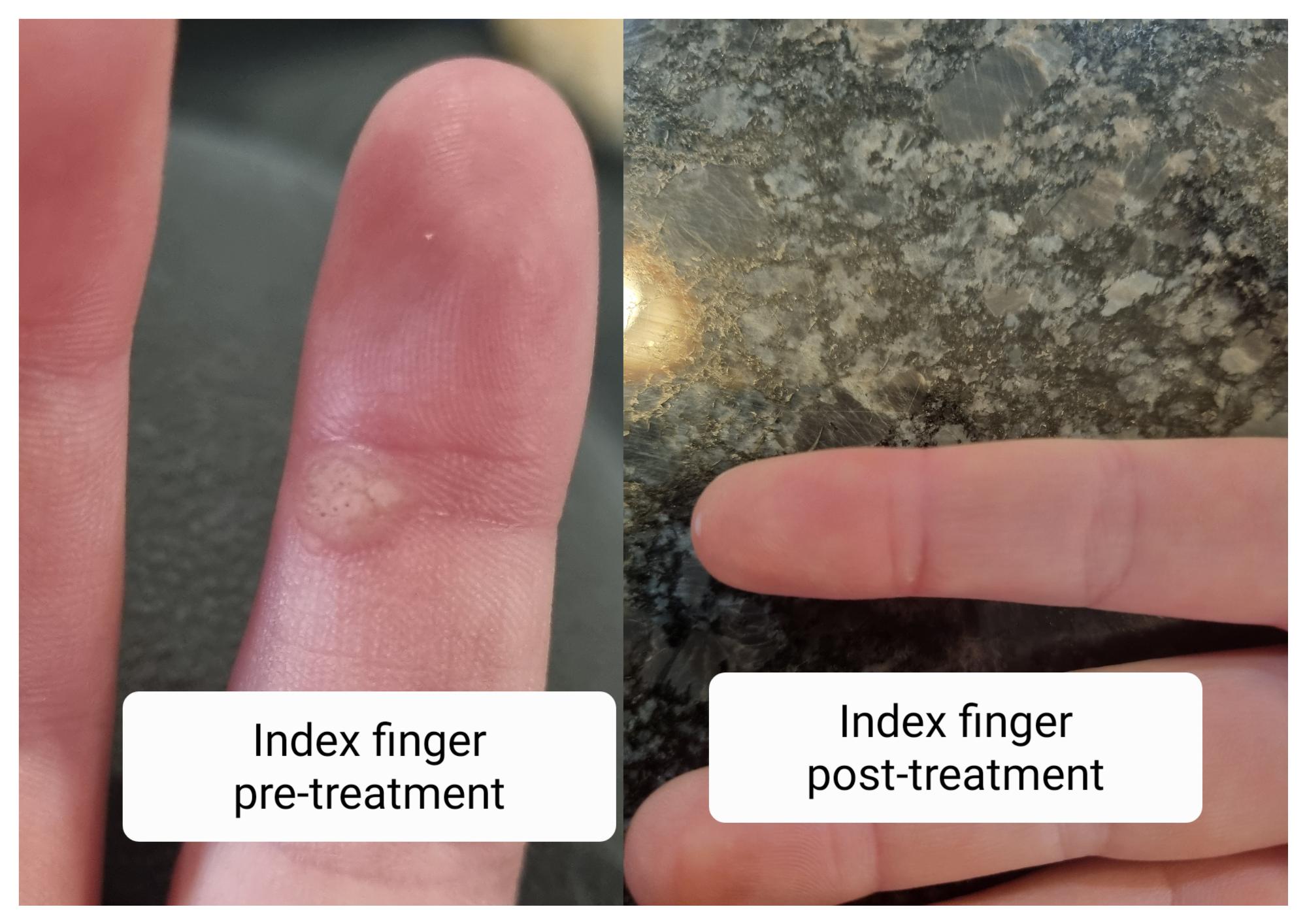 Before and after photos of a wart on the index finger, cleared after Swift treatment
