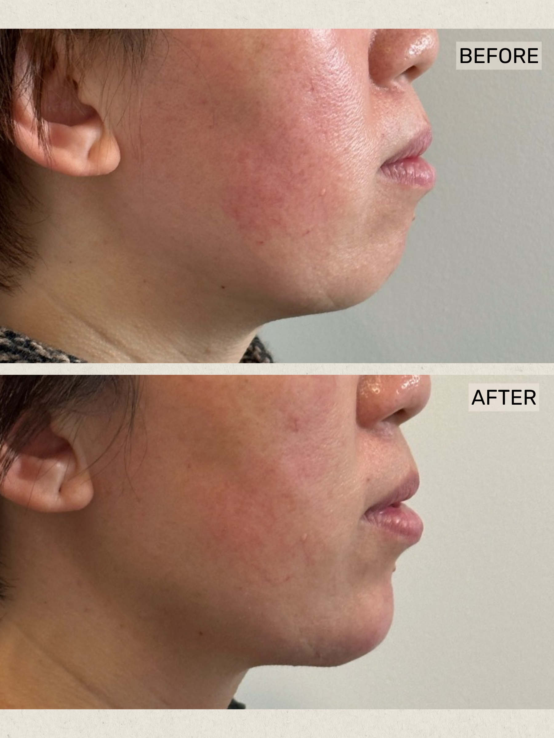 Dermal Filler (5).png