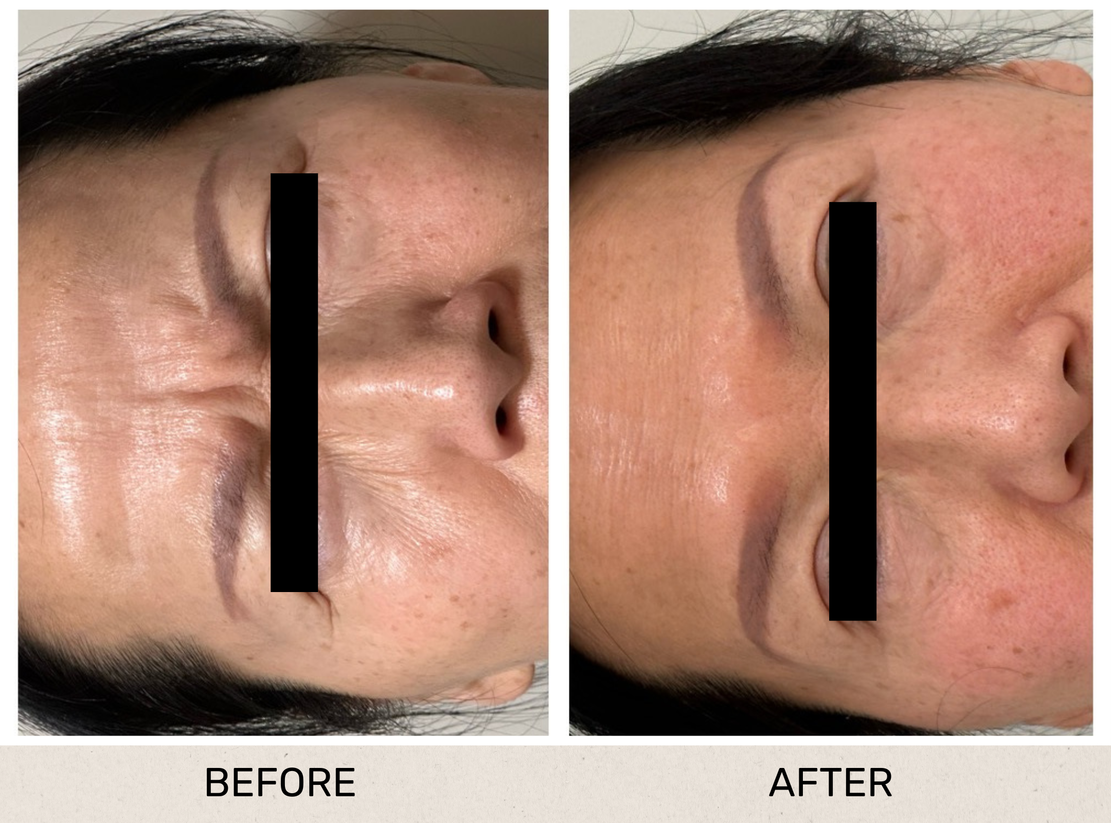 Anti Wrinkle Frown.png
