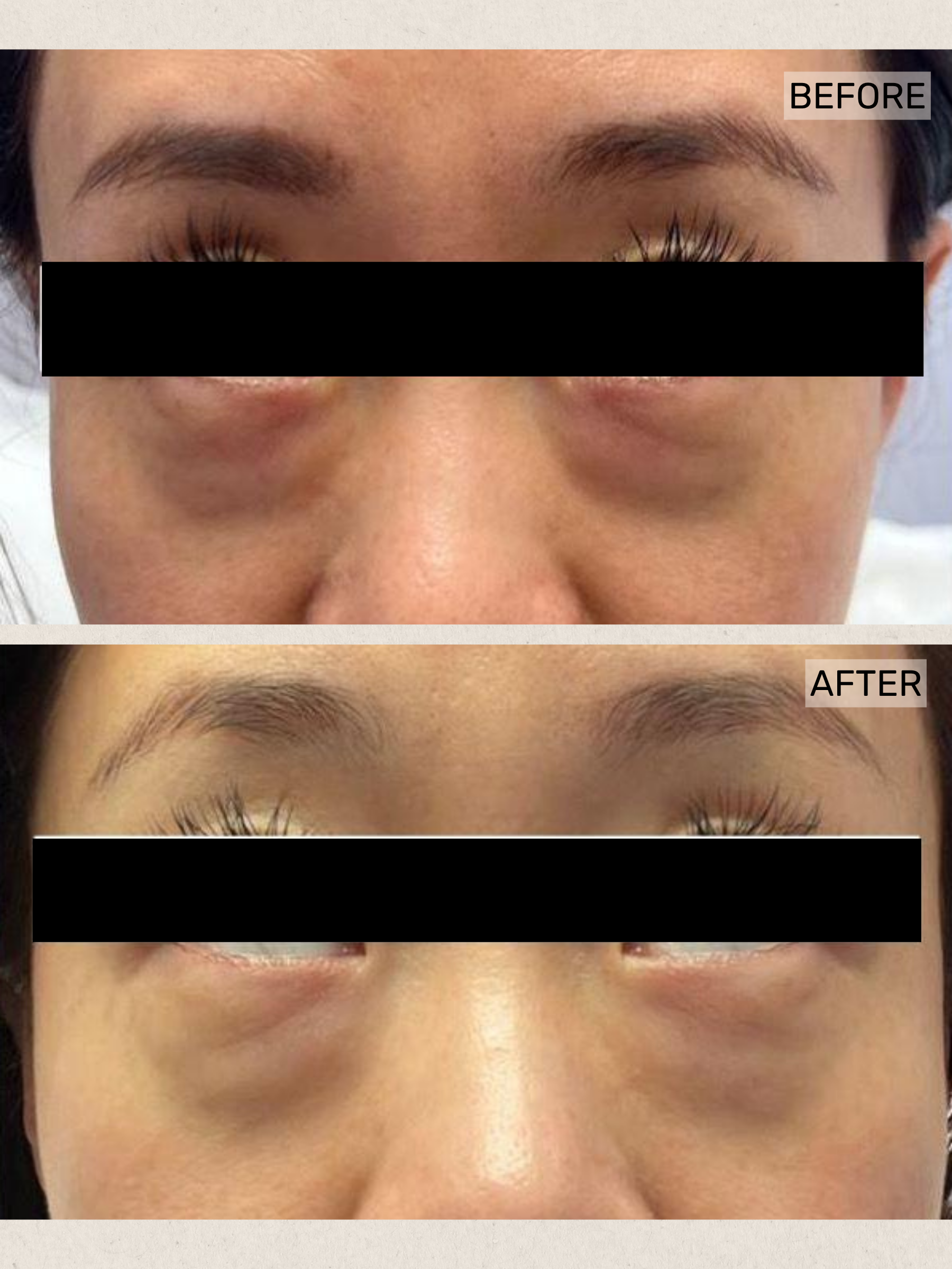 Under Eye Rejuvenation (2).png