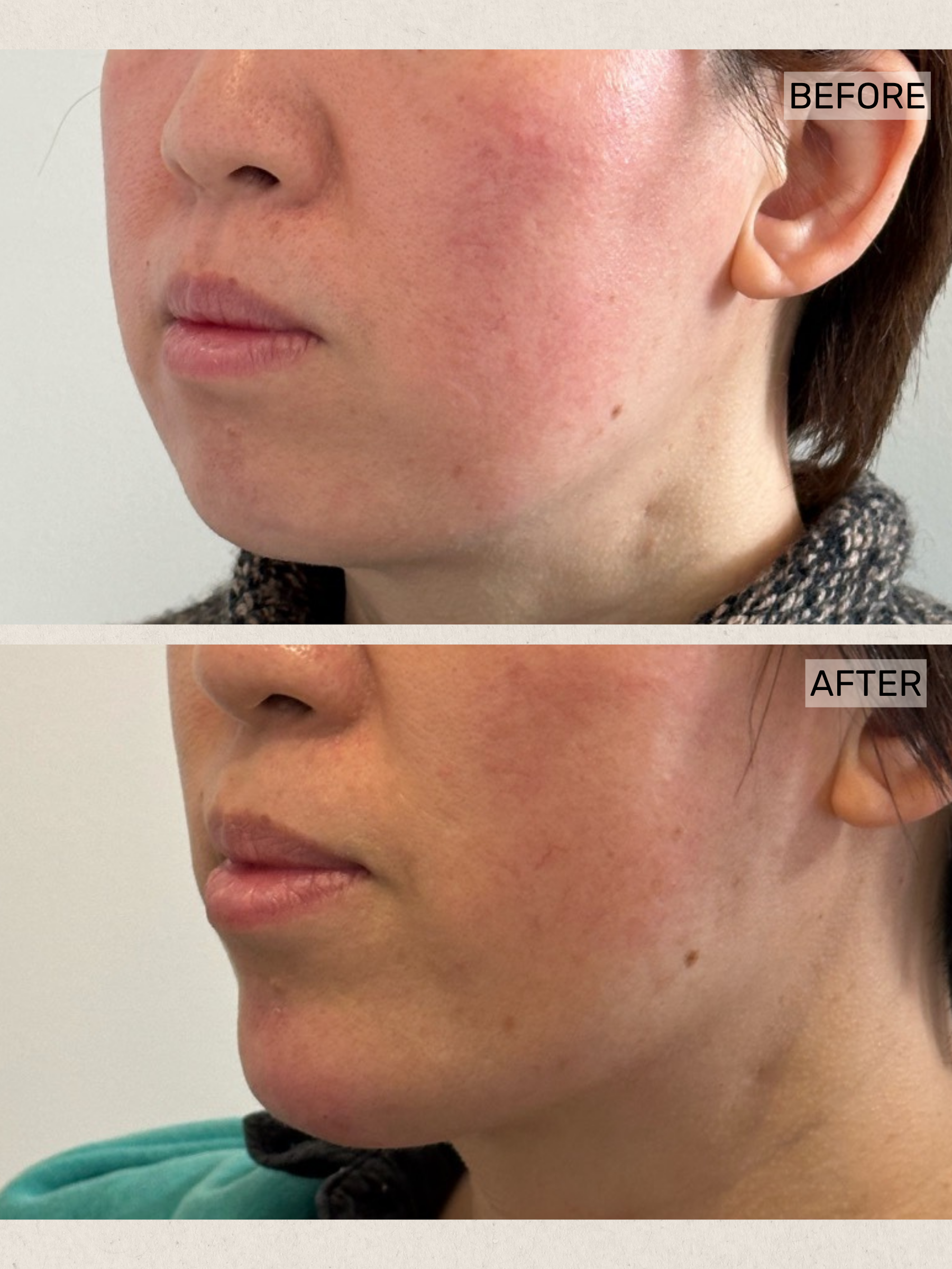 Dermal Filler (4).png