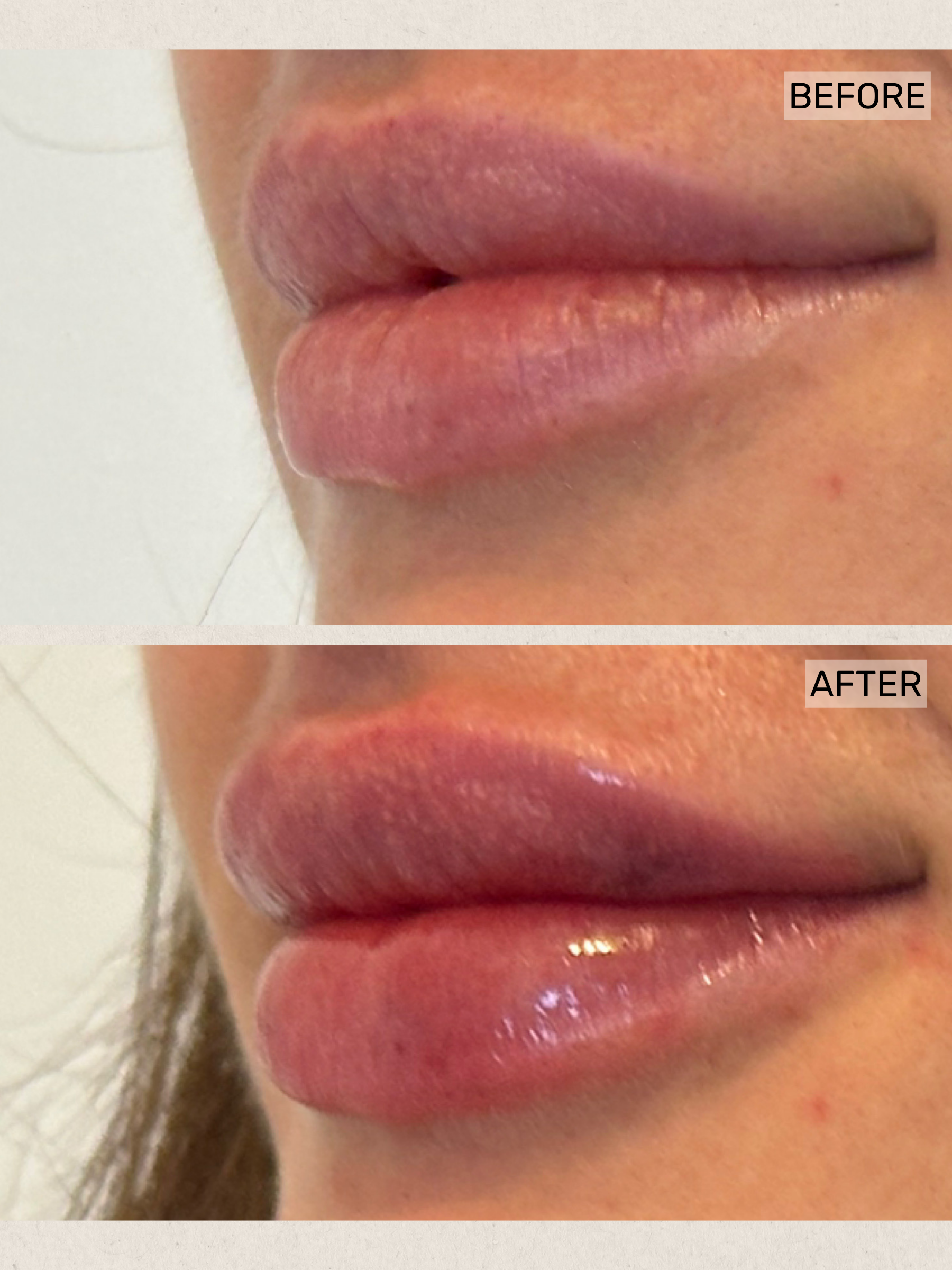 Dermal Filler.png