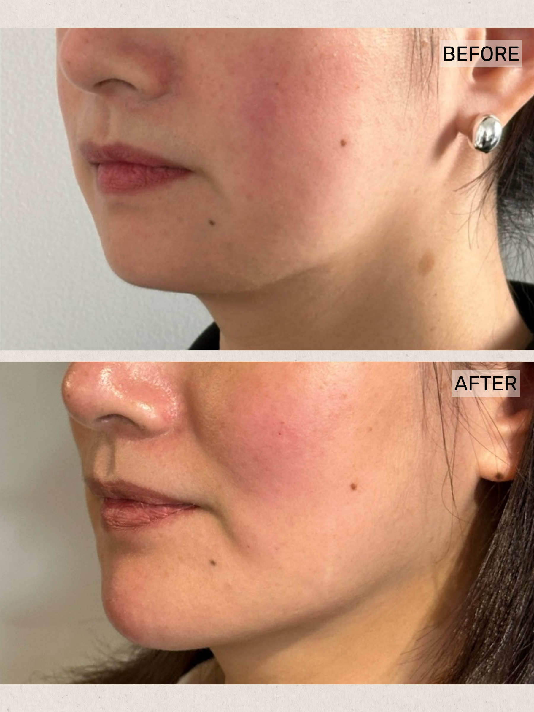 Dermal Filler (2).png