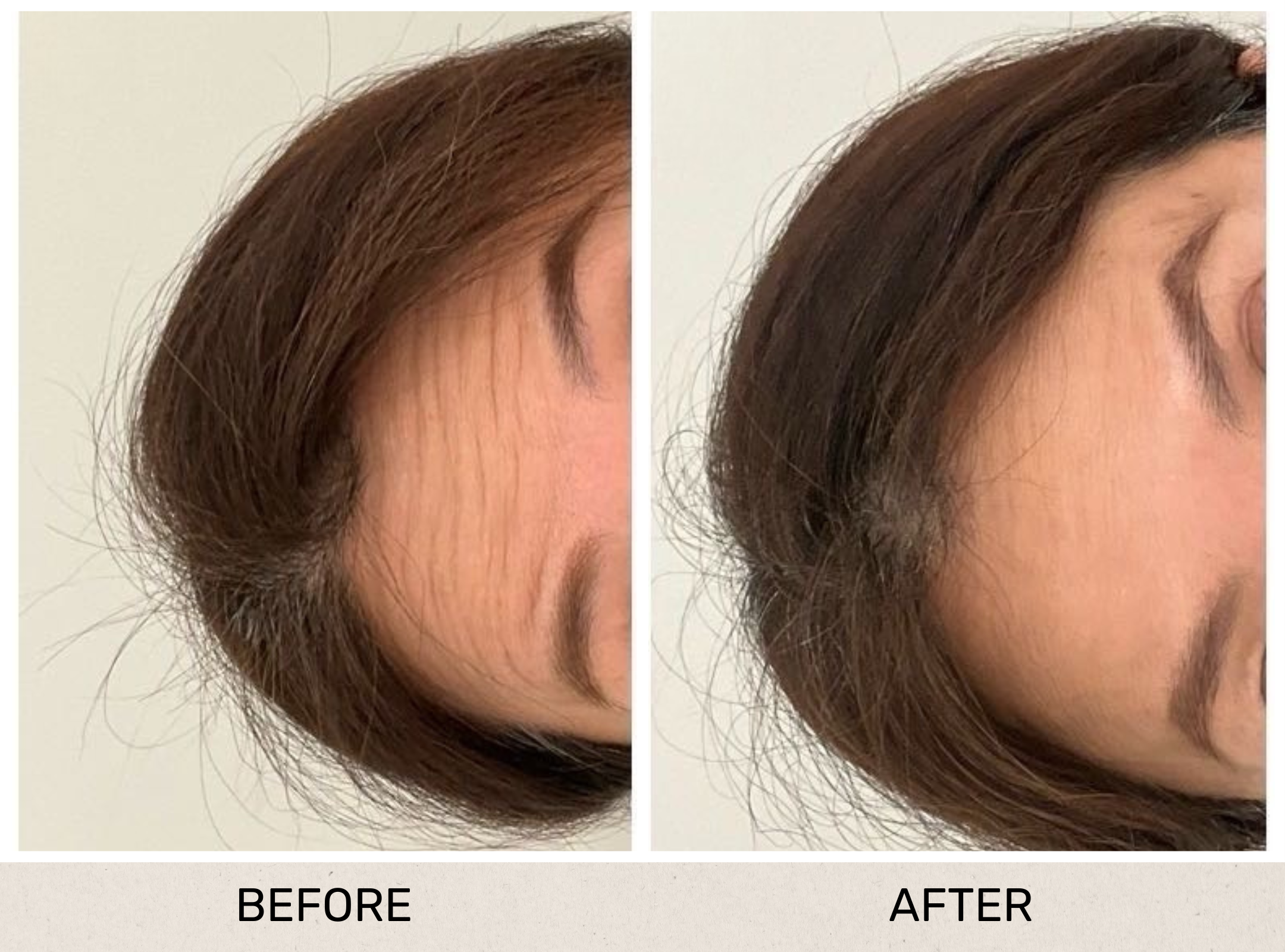 Forehead Antiwrinkle.png