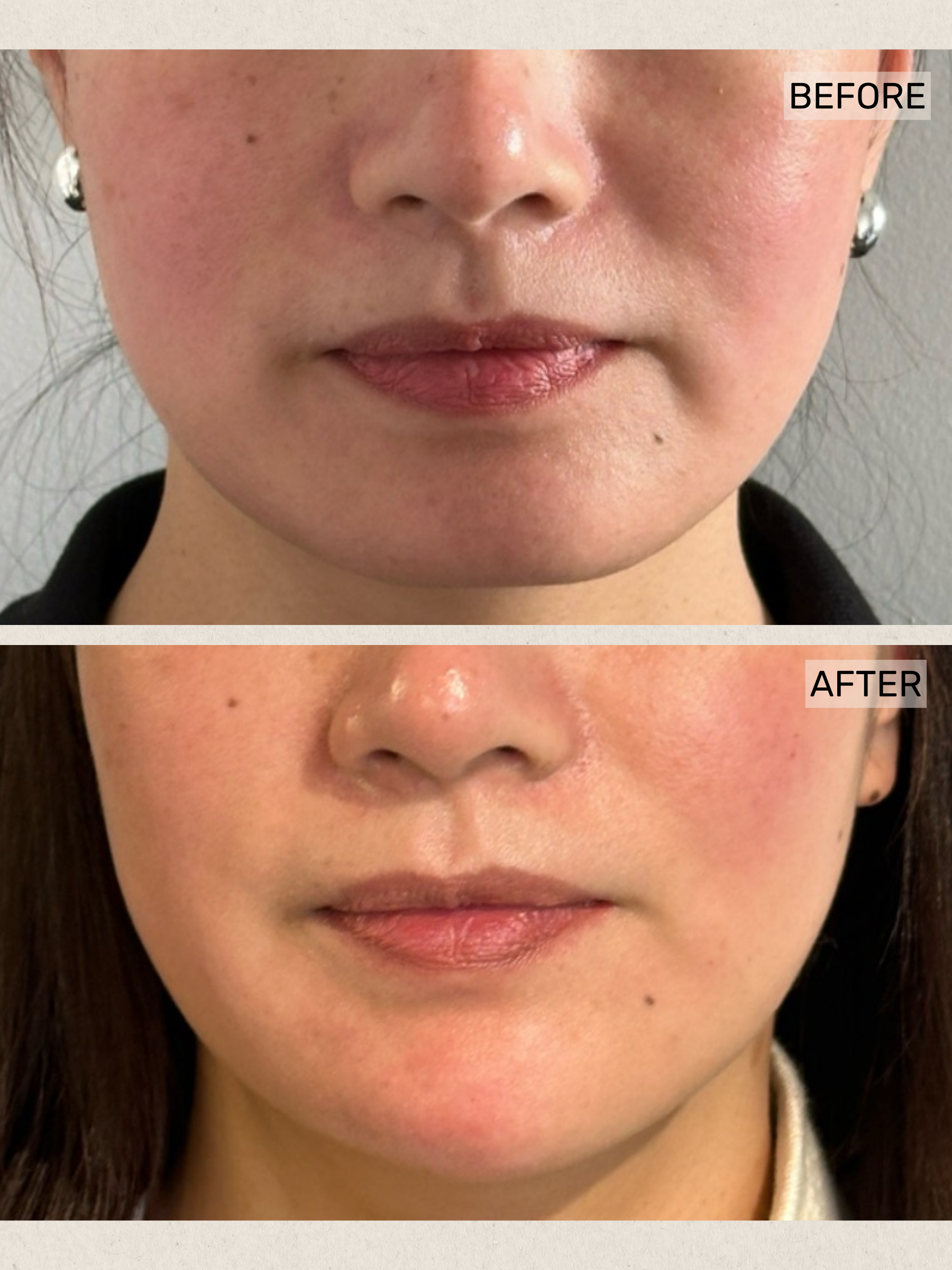 Dermal Filler (3).png