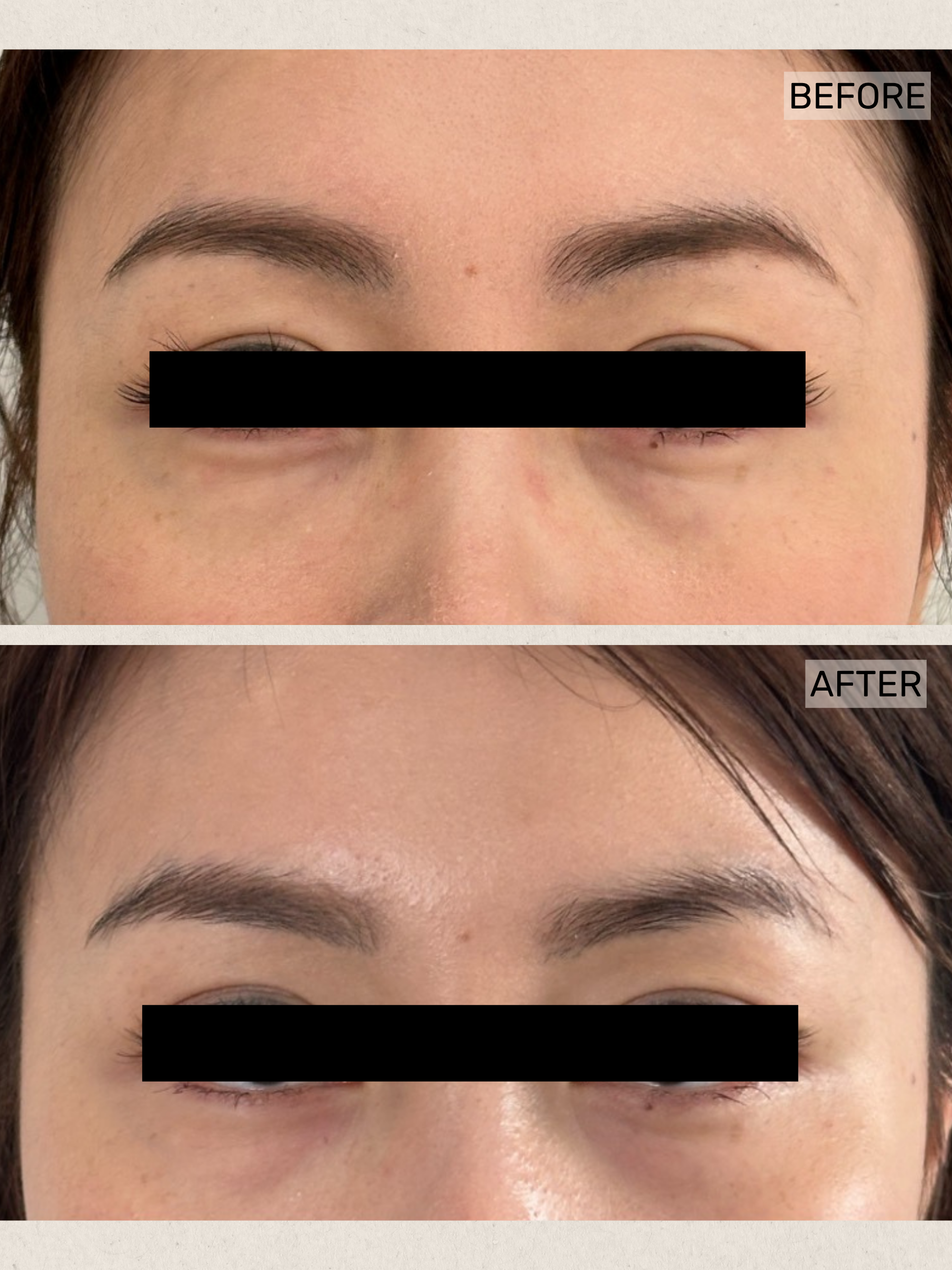 Under Eye Rejuvenation.png