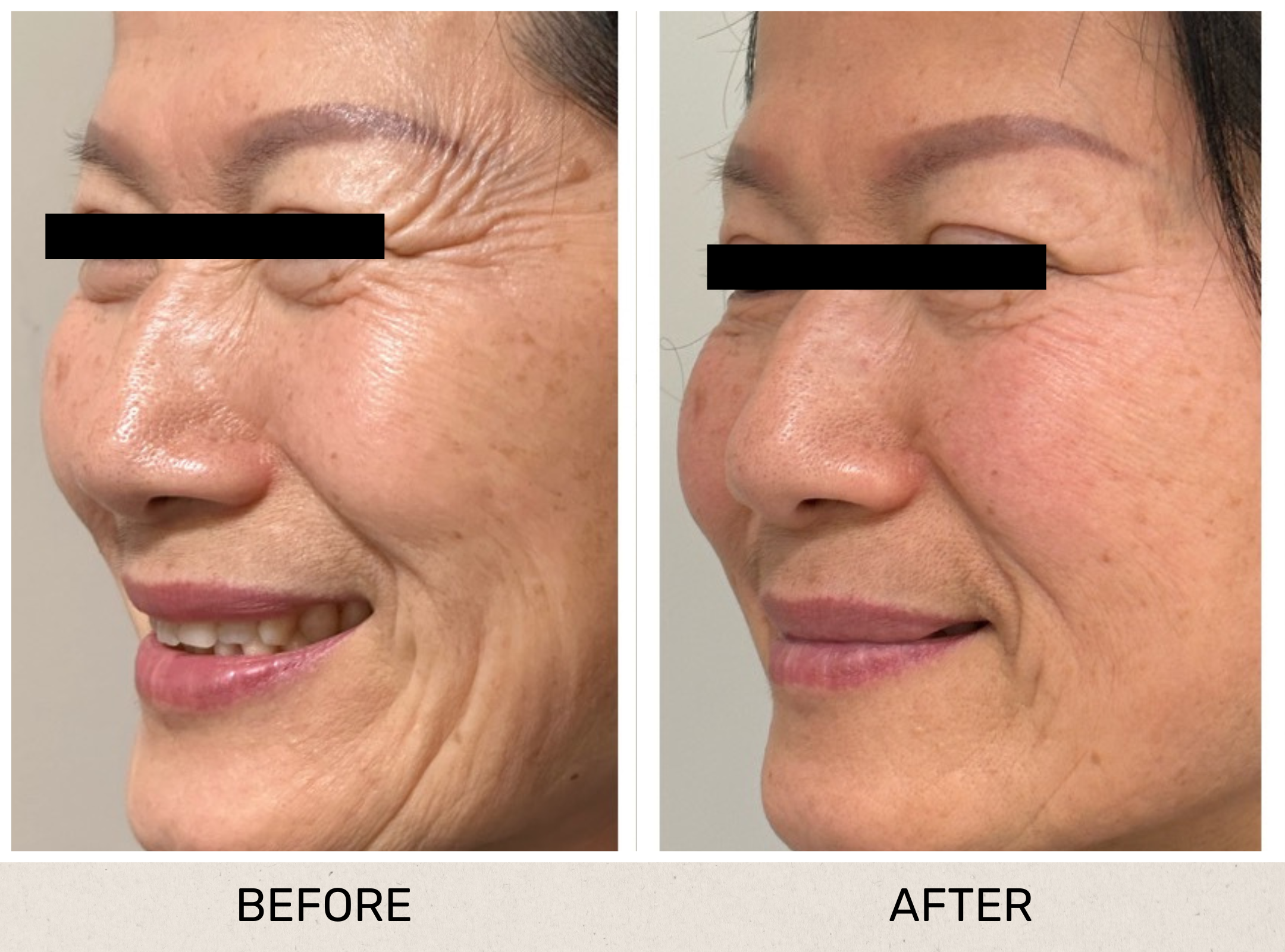 Anti Wrinkle Crows Feet.png