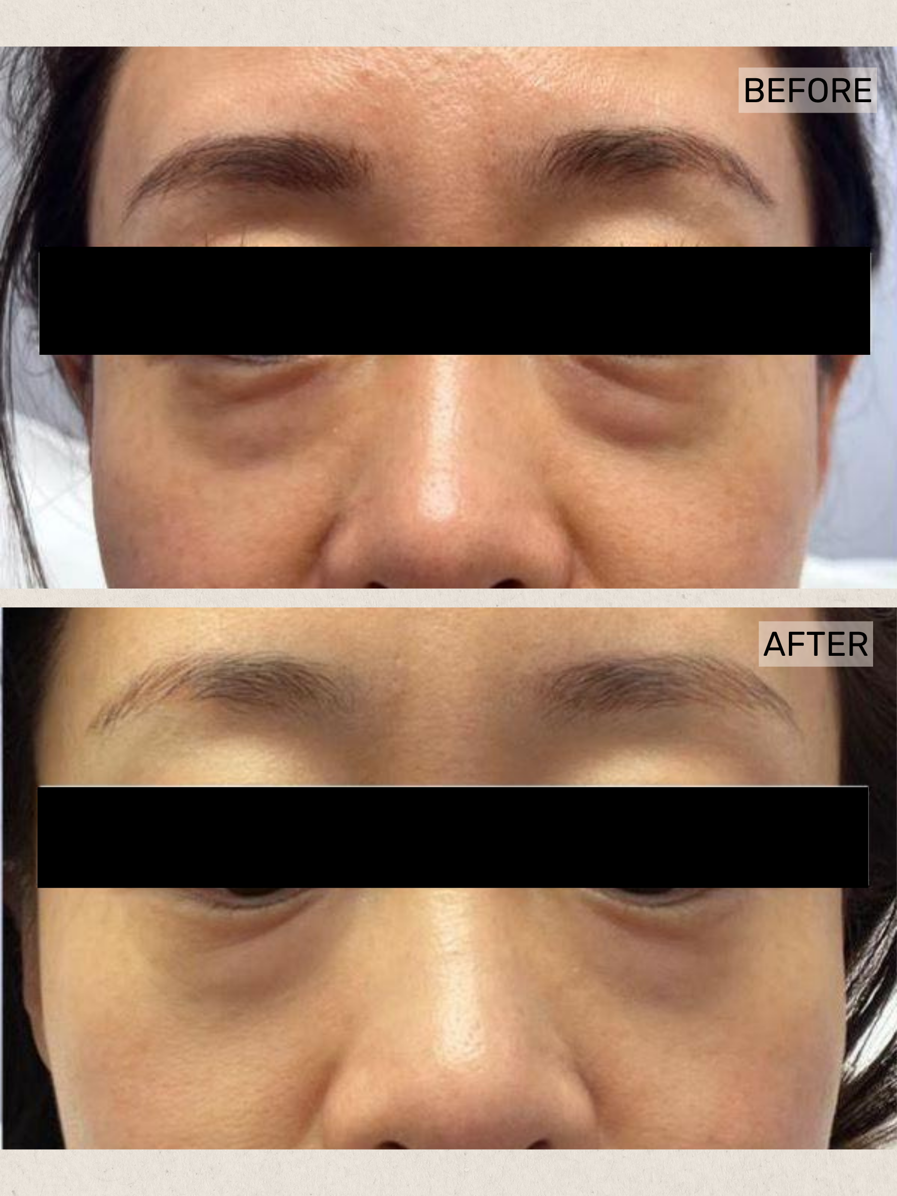 Under Eye Rejuvenation.png