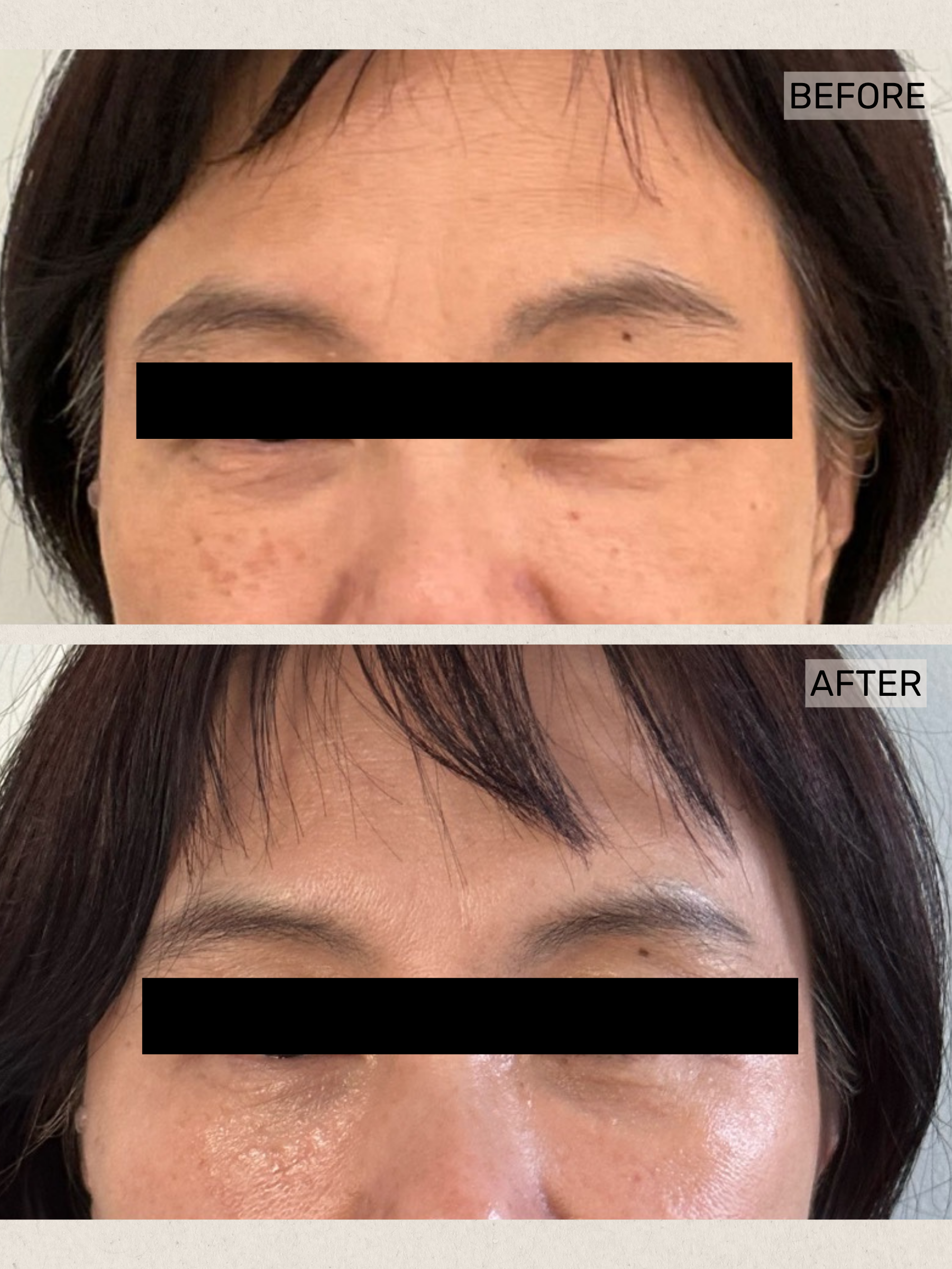 Under Eye Rejuvenation (2).png