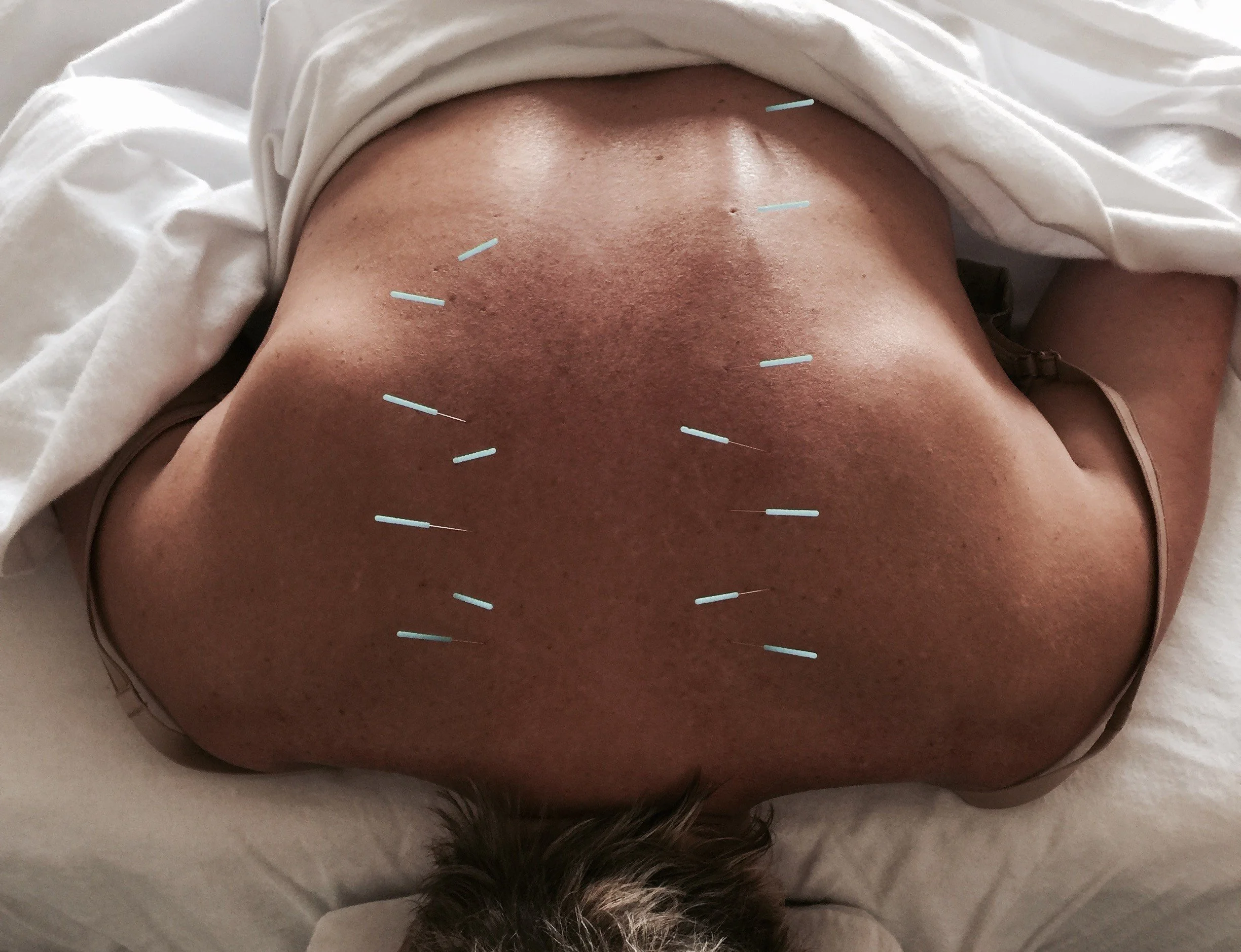 Back needles.jpg