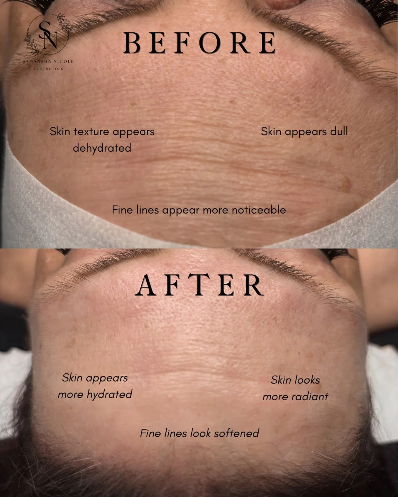 ✨ Anti-aging isn&rsquo;t about erasing every line. It&rsquo;s about improving your skin&rsquo;s overall health.

When skin is dehydrated, fine lines often become more noticeable and the complexion can lose its natural glow.

This customized facial fo