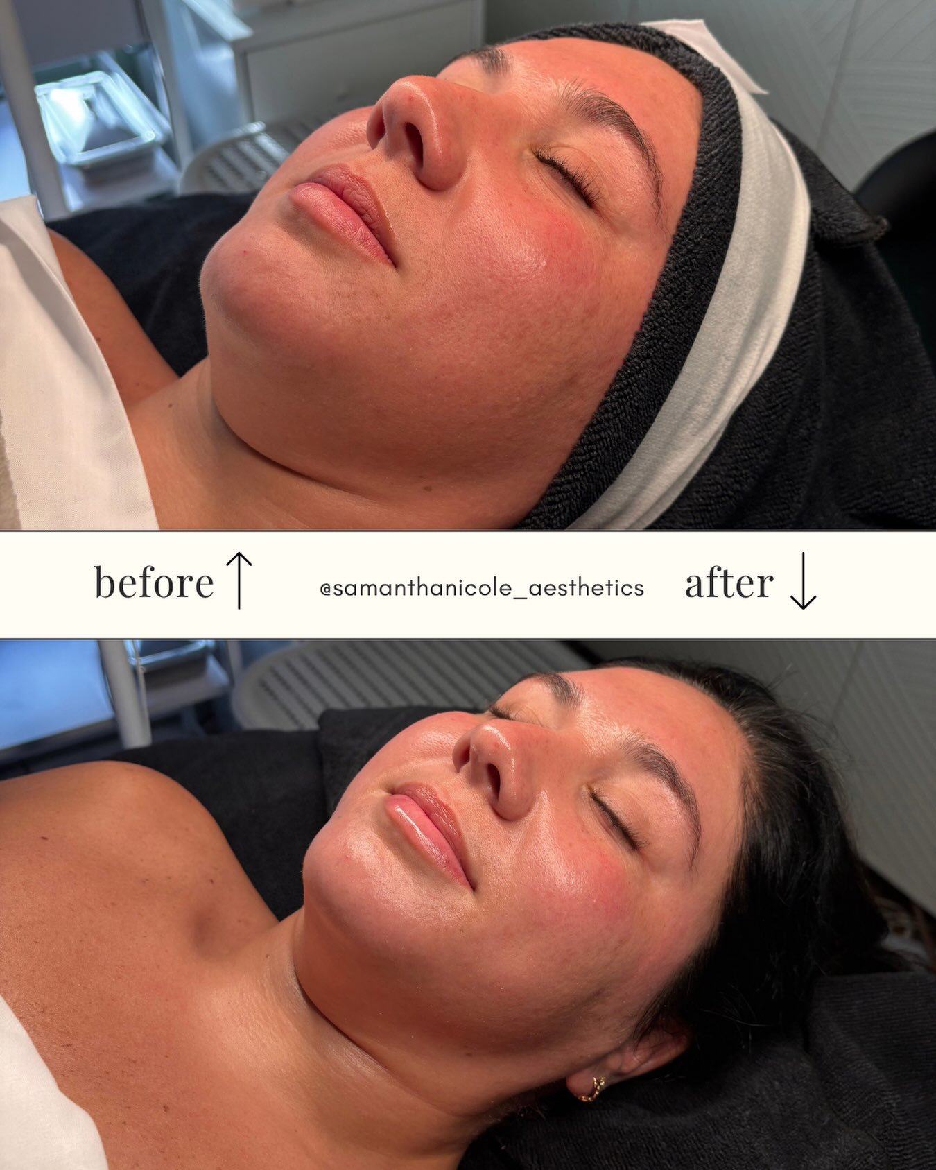 The post-facial glow ✨

Each facial is customized to support the skin&rsquo;s individual needs, with a focus on hydration, balance, and overall skin health.

The result: a refreshed, luminous complexion.

Because beautiful skin begins with intentiona