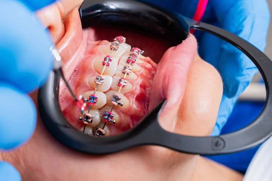 Paciente con tratamiento de ortodoncia y alineación dental