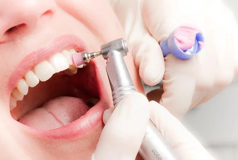 Limpieza dental profesional para eliminar sarro y placa bacteriana