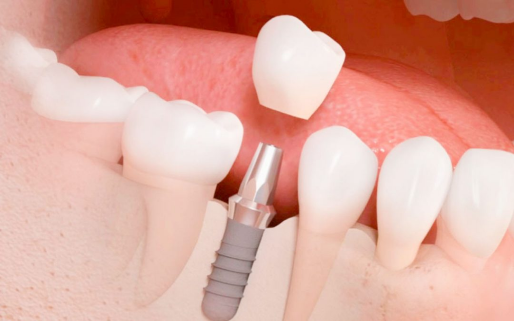 Rehabilitación dental mediante implantes dentales en Piedras Negras