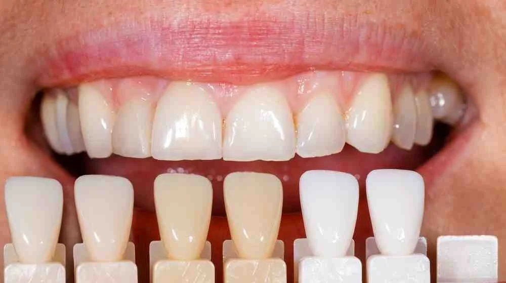 Resultado estético con carillas dentales de apariencia natural