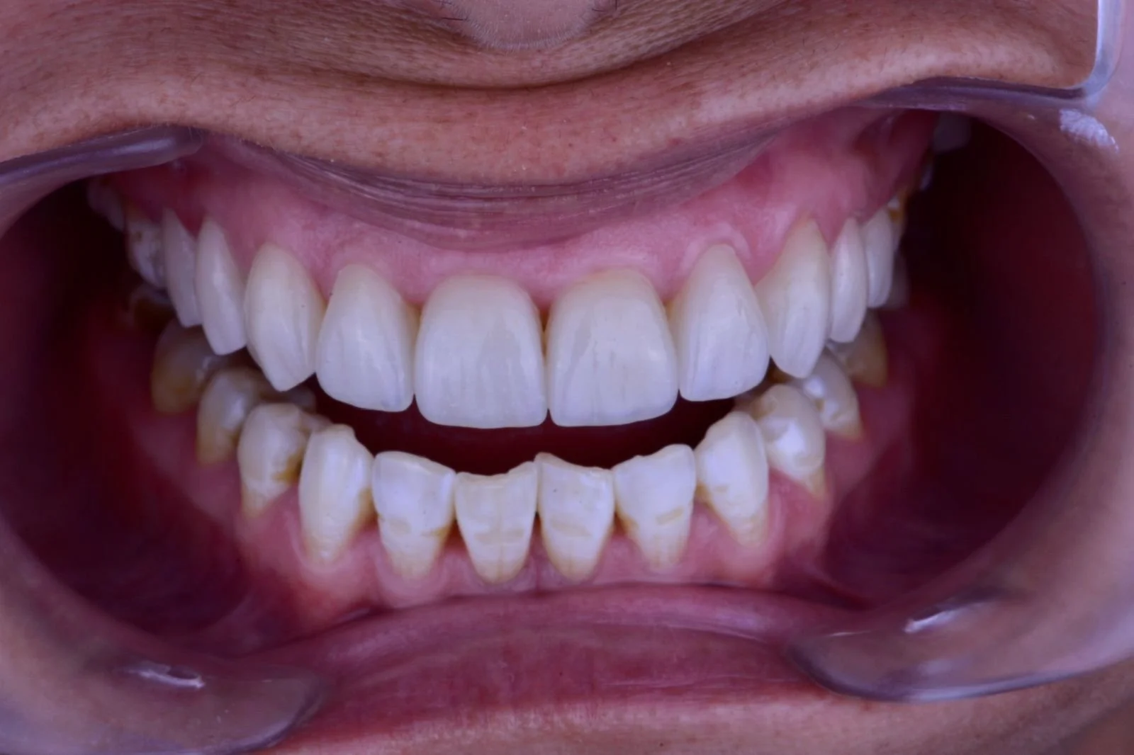 Resultado estético con carillas dentales de apariencia natural