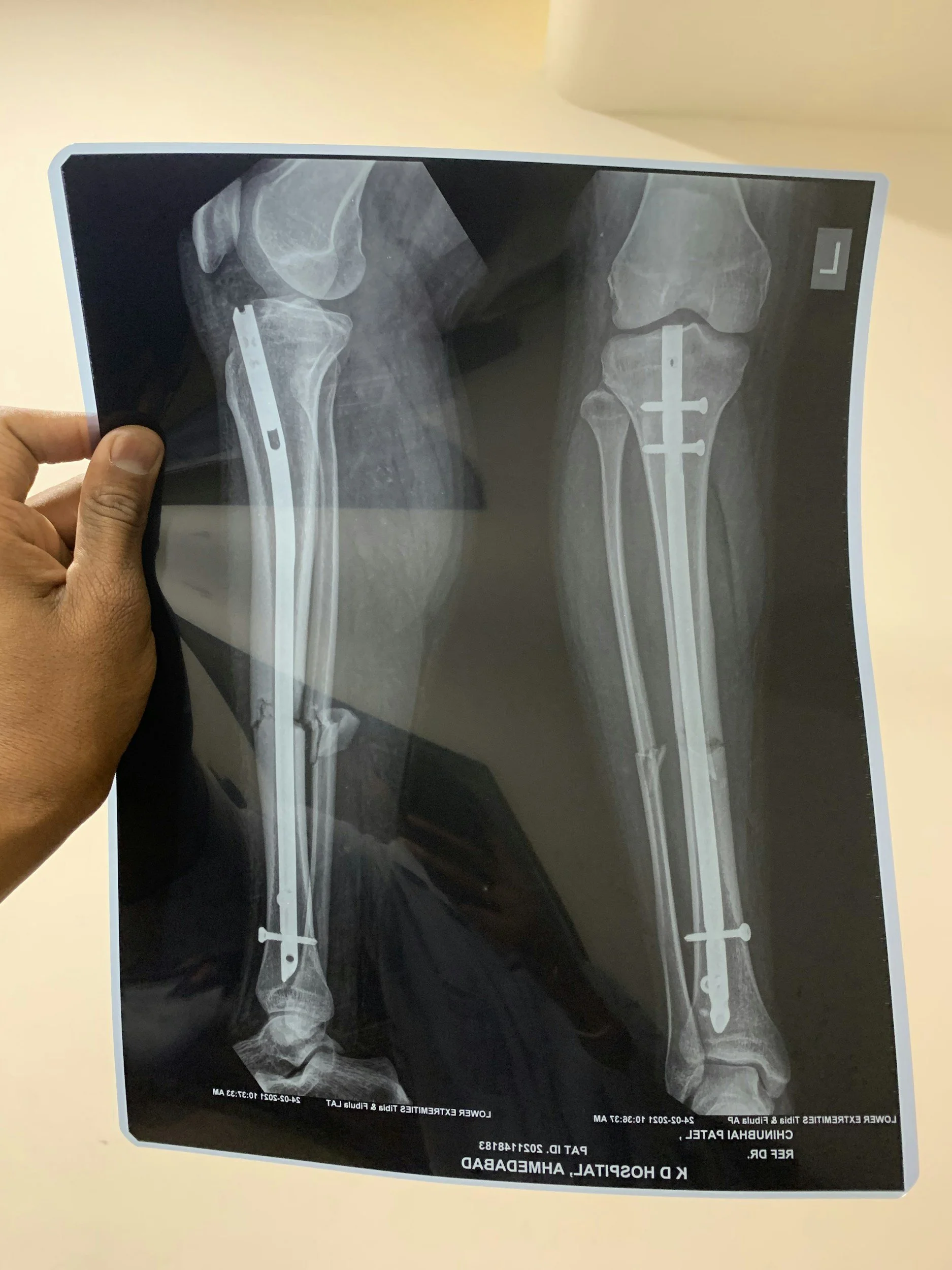 X-ray image of a left hip and femur showing surgical metal implants, including screws and a rod, after a hip fracture repair.