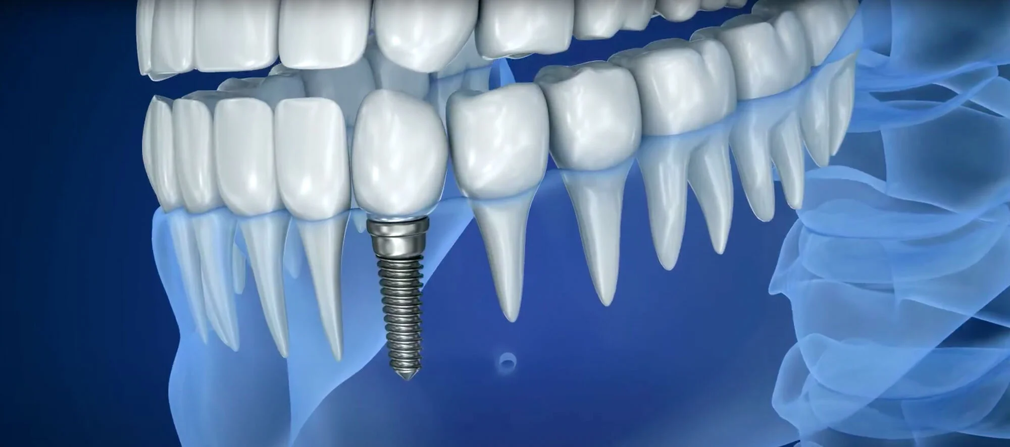 © IMPLANT DENTIST SYDNEY Dental Implant banner.jpg