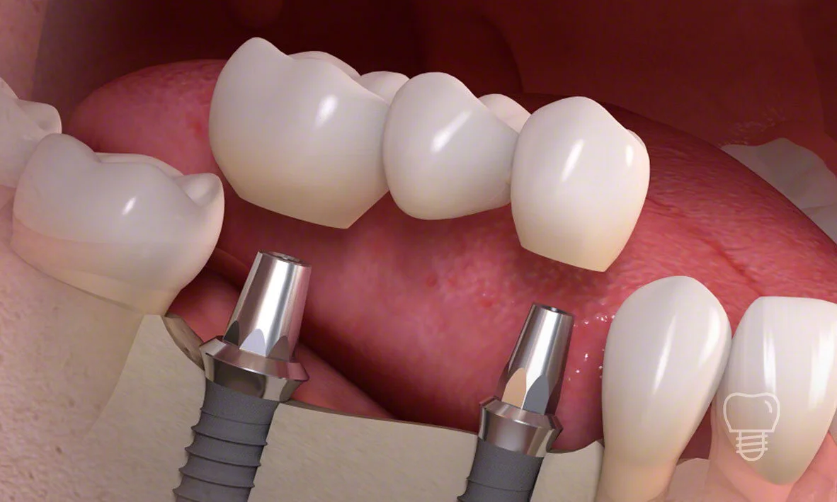 © Implant Dentist Sydney Multiple Teeth Implant.jpg