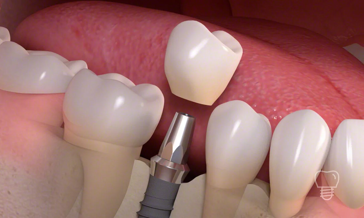 © Implant Dentist Sydney Single Implant.jpg