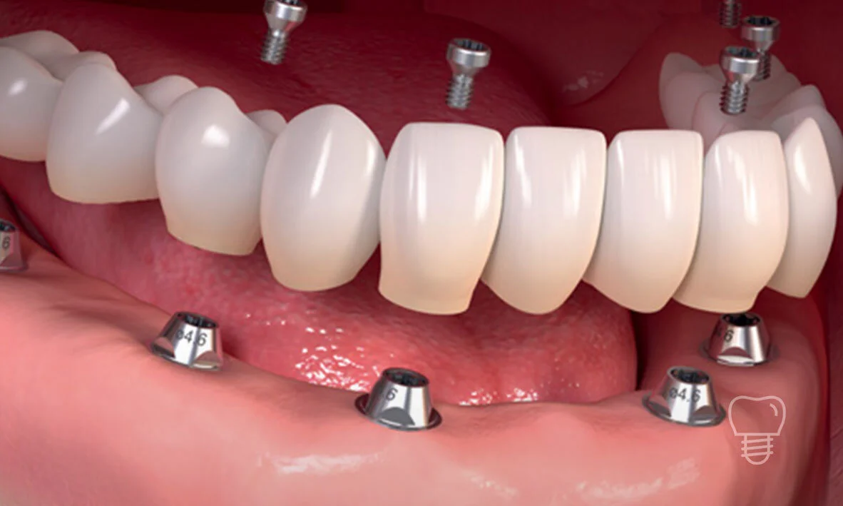 © Implant Dentist Sydney Full Mouth Implants.jpg