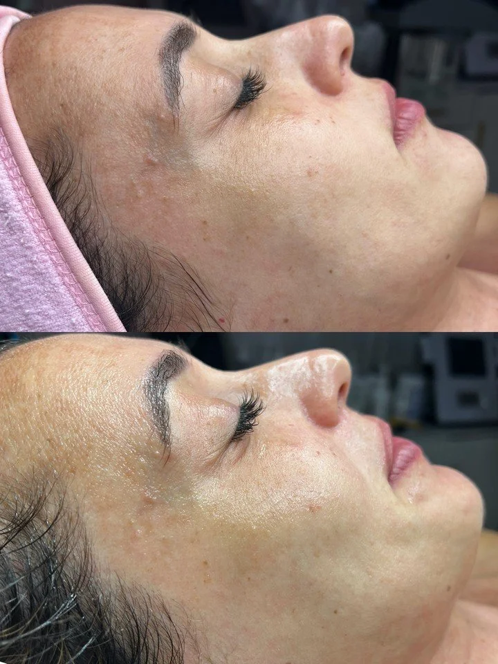 Smoother skin starts with the right plan, not guesswork ✨

At Haus of Beauty in Waverley, our experienced dermal therapists focus on real skin results with a calm, tailored approach. If you&rsquo;ve been considering microneedling Waverley locals trus