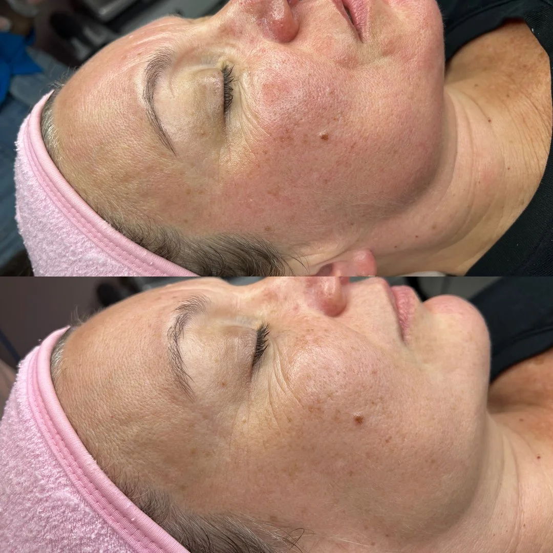 Ready for calmer, smoother-looking skin in Waverley? ✨ At Haus Of Beauty, our experienced dermal therapists tailor each treatment to your skin, with a careful consultation and clear aftercare so you feel looked after from start to finish.

If you&rsq