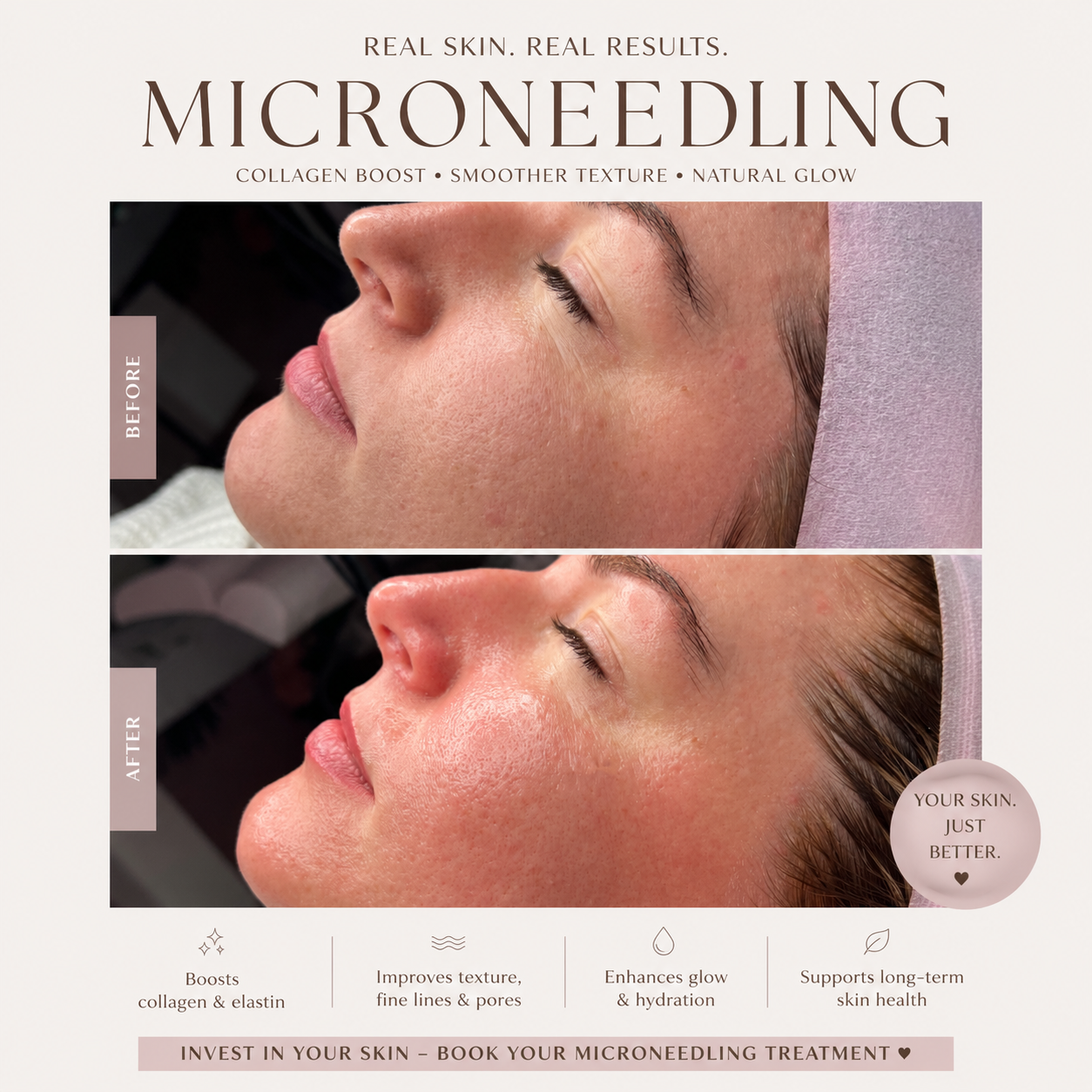 Unlock Radiant Skin with Skin Needling at Haus of Beauty