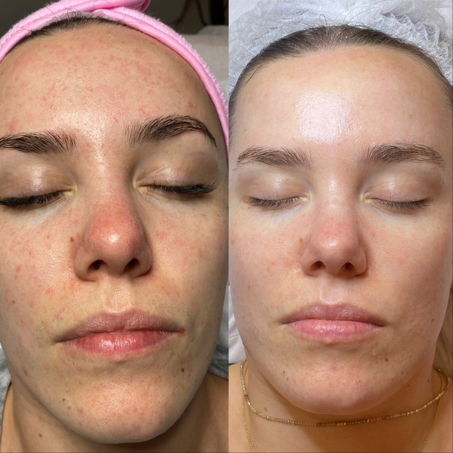 Your skin deserves a little extra attention as spring settles in 🌸

At Haus Of Beauty in Waverley, our experienced dermal therapists offer microneedling Waverley and skin needling Bondi to gently stimulate collagen, refine texture and restore a fres