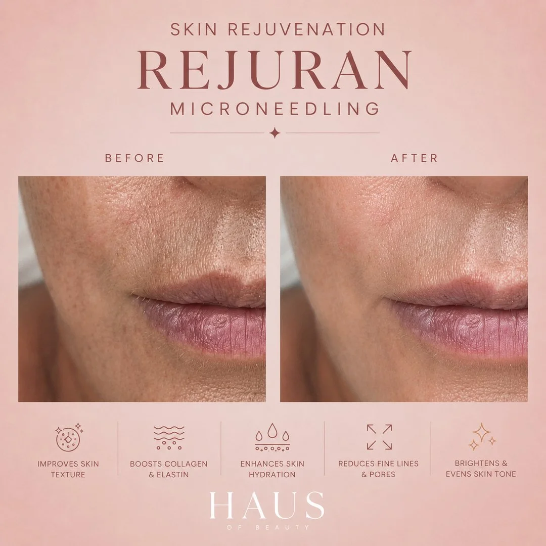 Real results, right here ✨

This before and after shows the difference Rejuran microneedling can make. Smoother texture, softer fine lines, refined pores and a brighter, more even skin tone. By stimulating collagen and elastin while deeply hydrating,