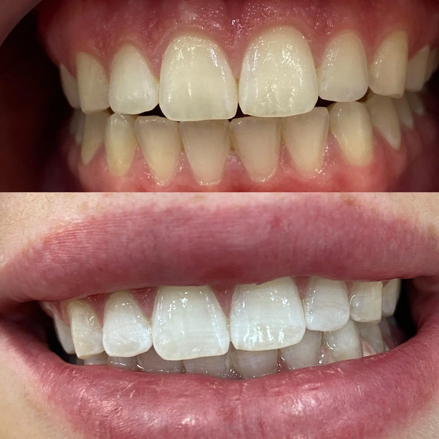 That smile says it all 😁

These before and after results show the difference a professional teeth whitening Waverley treatment can make, with noticeably brighter, more even teeth. At Haus Of Beauty, our experienced team tailors every session to your