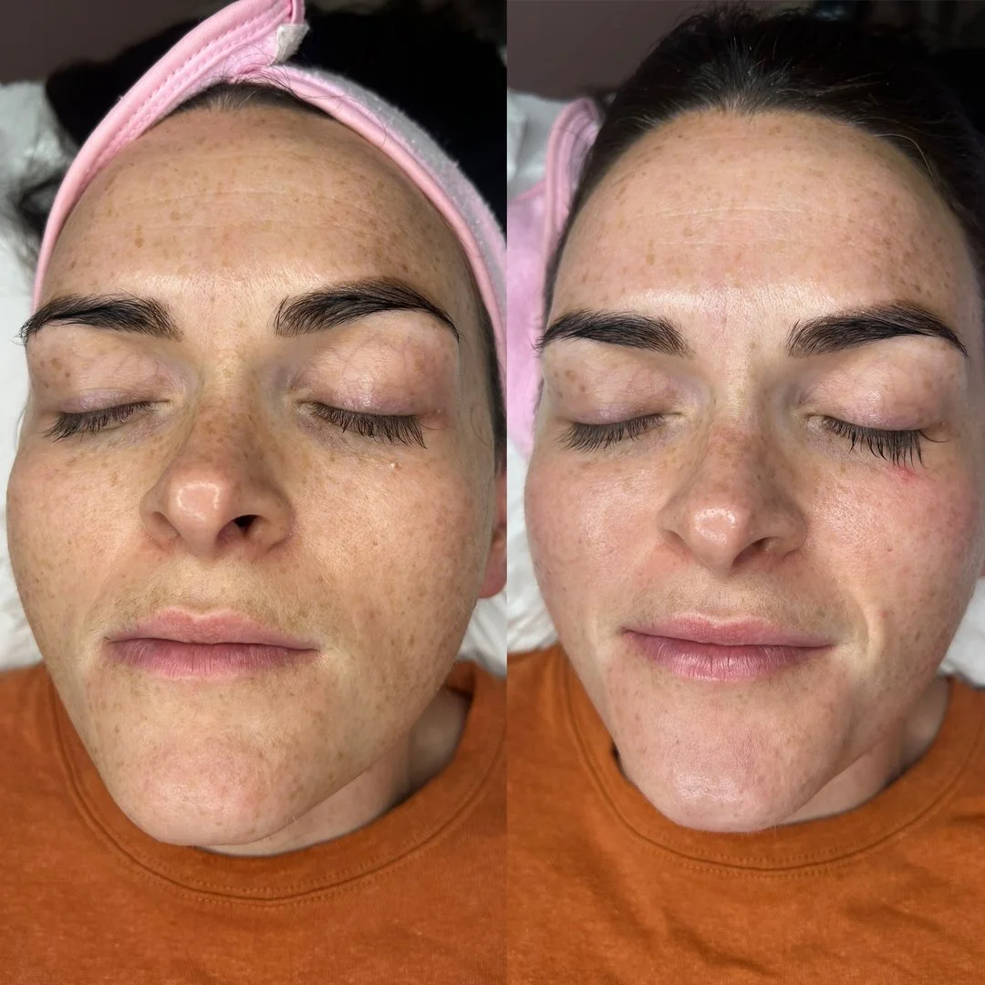 Brighter, smoother, glowing ✨

This before and after speaks for itself. Skin texture refined, dullness lifted, and a fresh, radiant glow that looks completely natural. That's the power of professional skin needling done by experienced dermal therapis