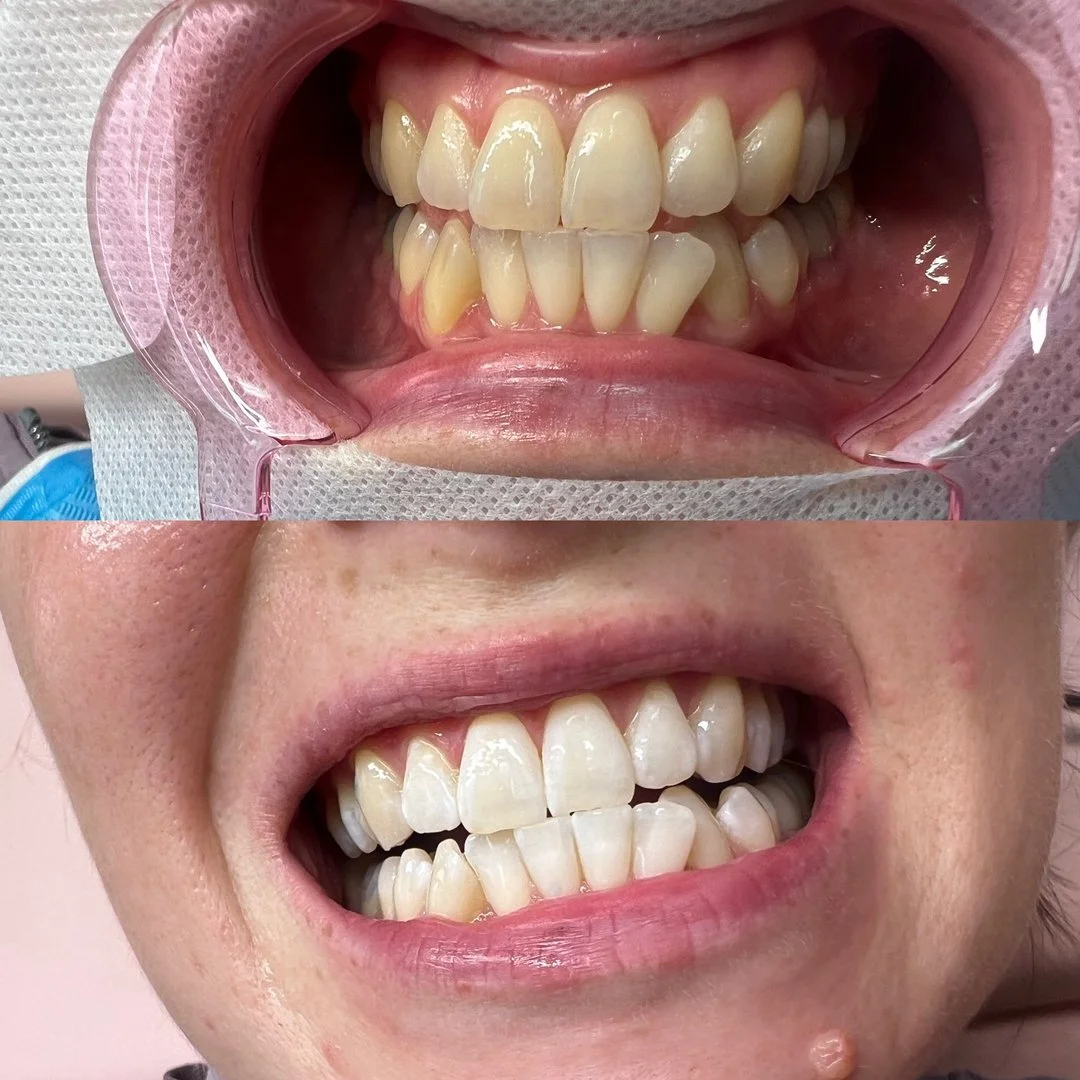 Your smile deserves its moment in the spotlight.

A brighter, whiter smile can transform your whole look, and the results speak for themselves. At Haus Of Beauty in Waverley, our teeth whitening Waverley clients rave about lifts away everyday stains 