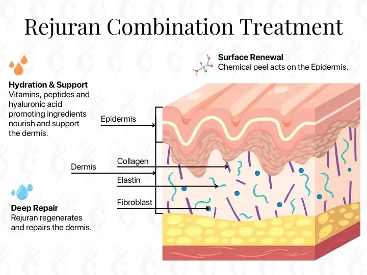 Diagram illustrating Rejuran skin treatment process, showing surface renewal with chemical peel, hydration support with vitamins and peptides, and deep repair with regranulation of the dermis by fibroblasts.
