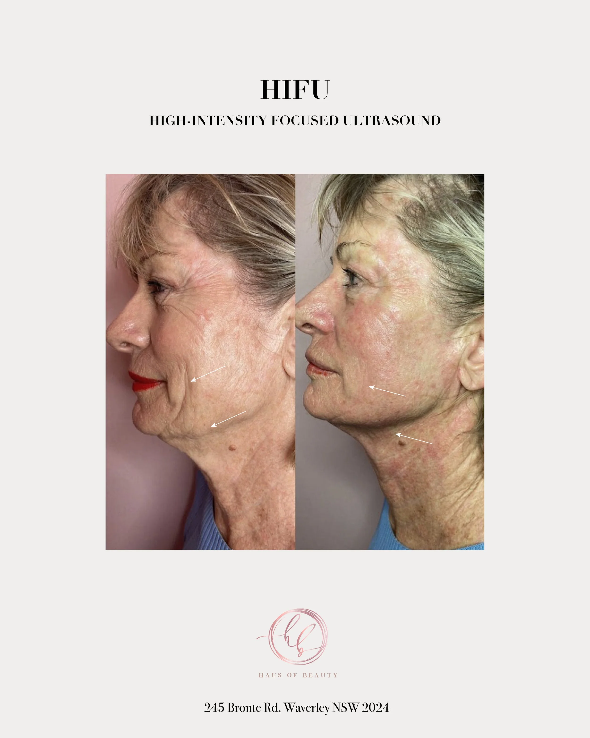 Promotional flyer for Haus of Beauty, featuring before and after photos of a woman's face showing skin improvement. Address: 245 Bronte Rd, Waverly NSW 2024.