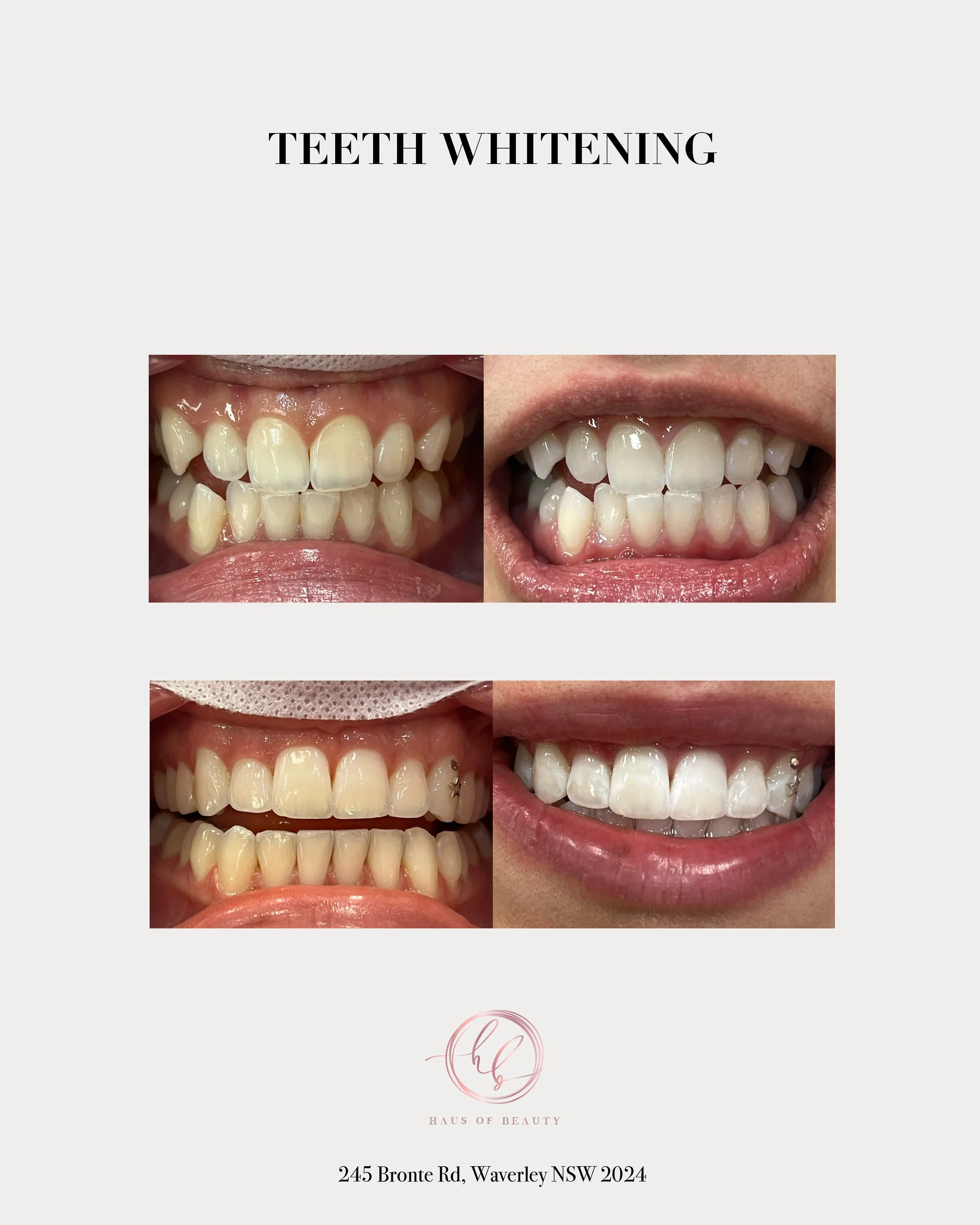 Teeth whitening before and after Waverley NSW | Haus Of Beauty 
 'TEETH WHITENING' above the images. The logo 'Haus of Beauty' and the address 245 Bronte Rd, Waverly NSW 2024
