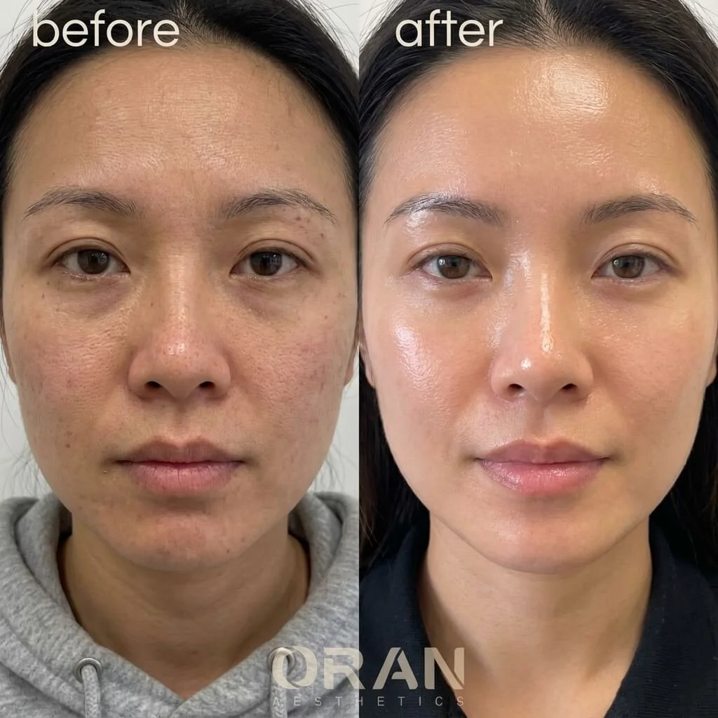 Side-by-side comparison of a woman's face before and after skincare treatment, showing improvements in skin texture, tone, and clarity.