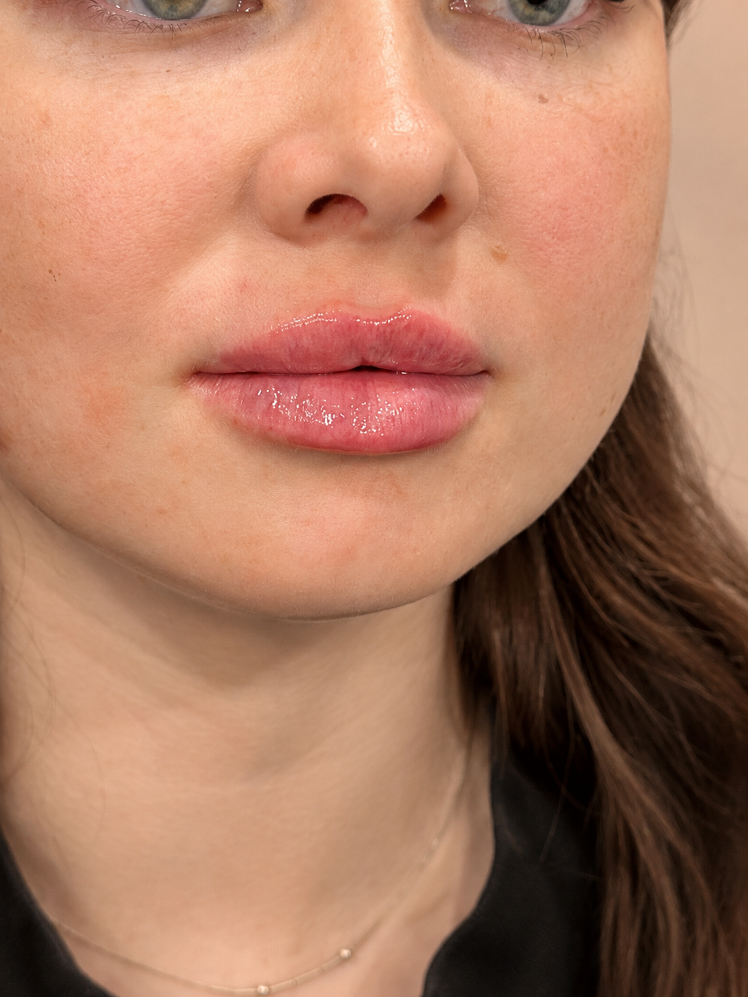 Natural-looking lip filler result at FORMED. in Silver Spring, Maryland