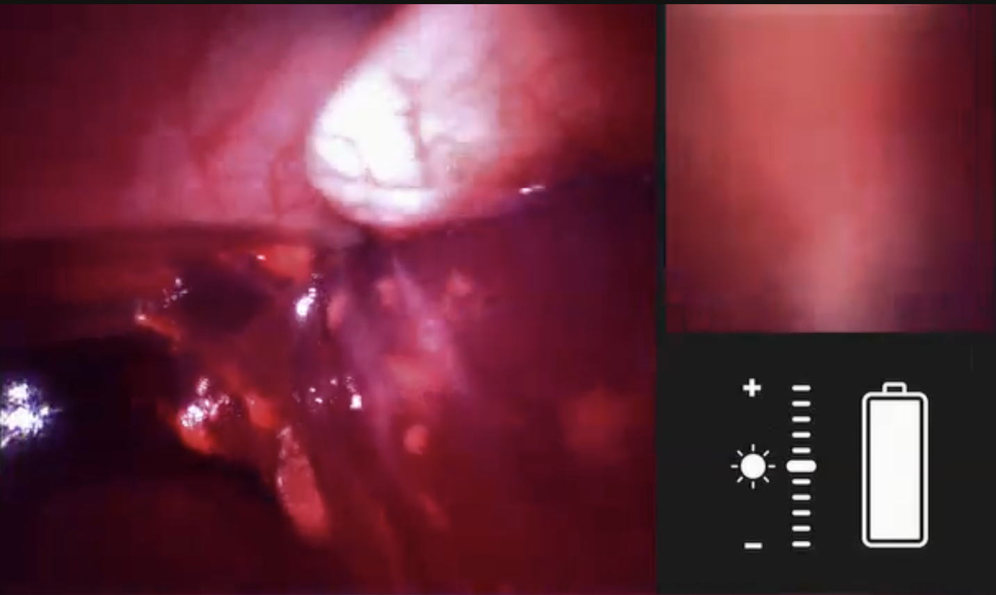 Close-up view of a medical procedure inside a body, showing tissues and a surgical instrument, with a control overlay on the right side.