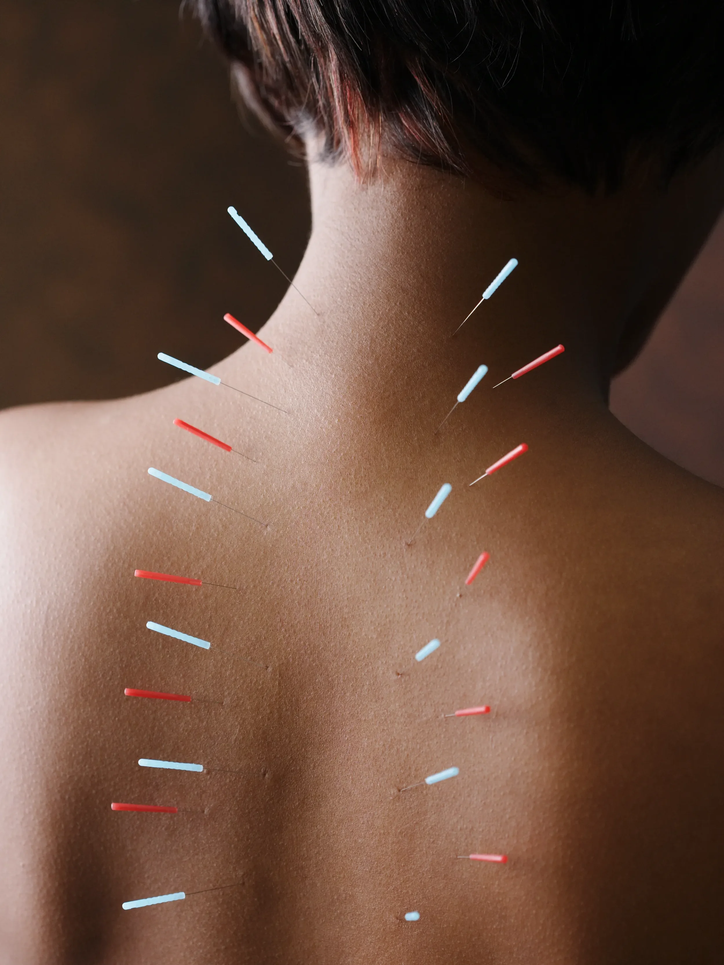 Follow-Up Acupuncture Treatment