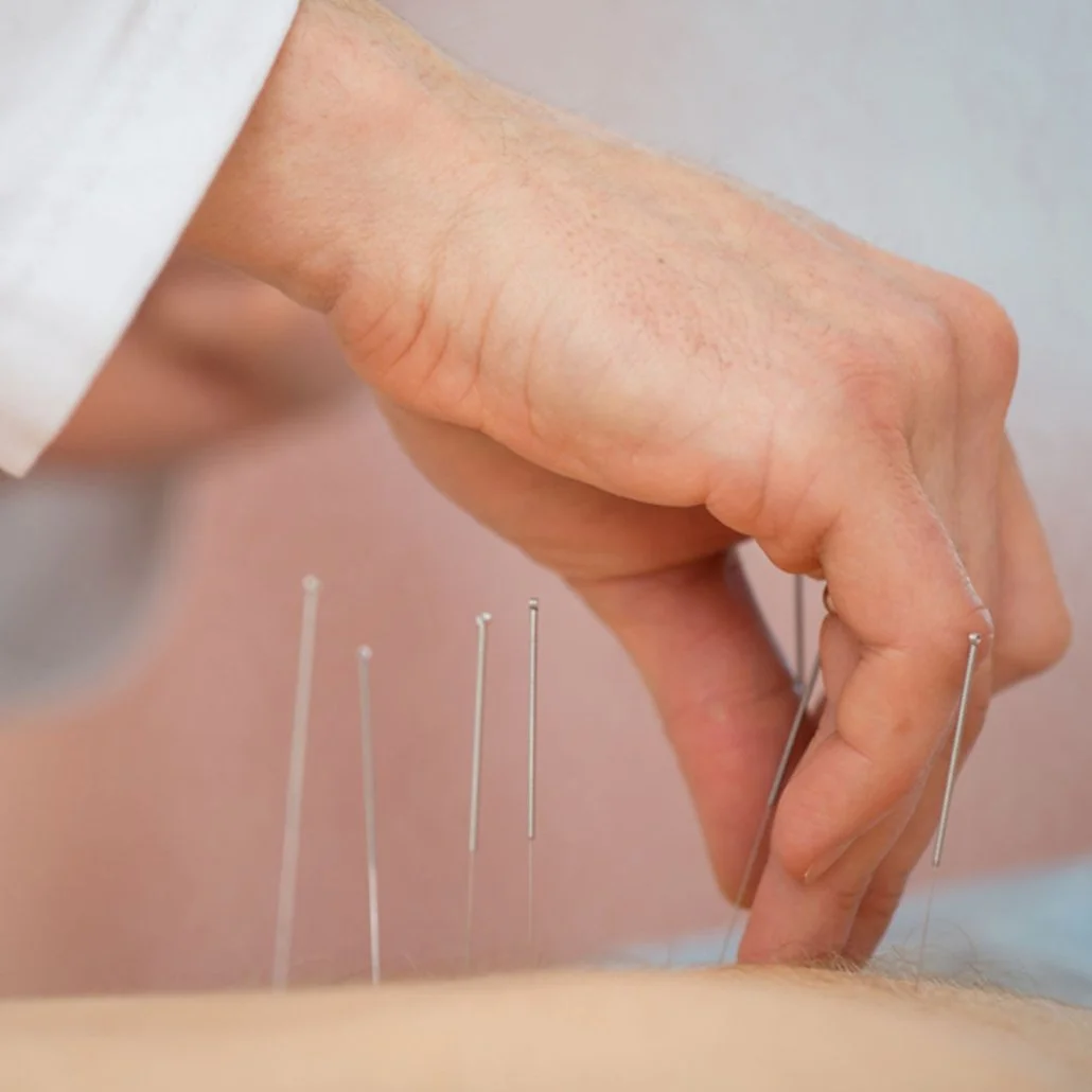 Initial Acupuncture Treatment