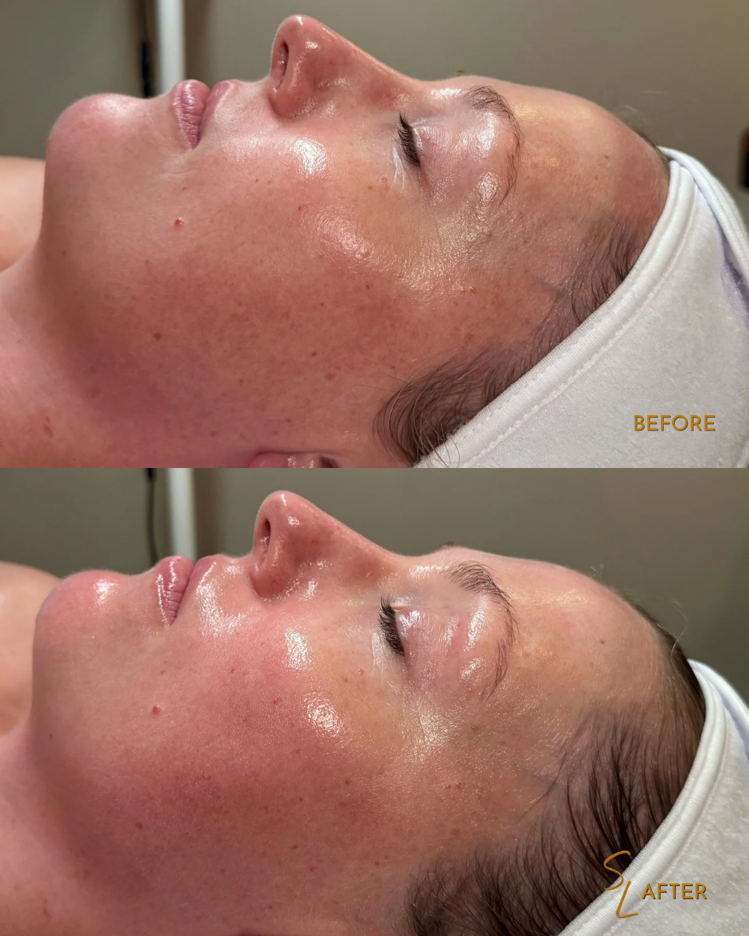 Before and after images of a person's face showing improved skin appearance after a skincare treatment. The skin appears smoother and more glowing in the after photo.