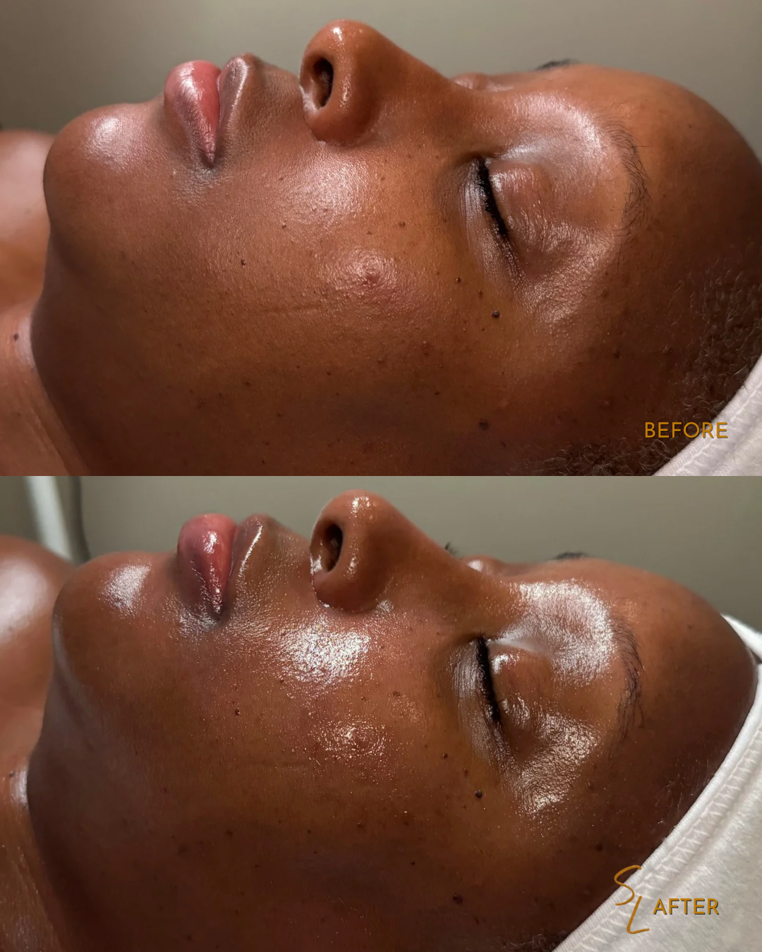 Side-by-side comparison of a person's face showing skin improvement after a facial treatment, with a 'before' image at the top and an 'after' image at the bottom.