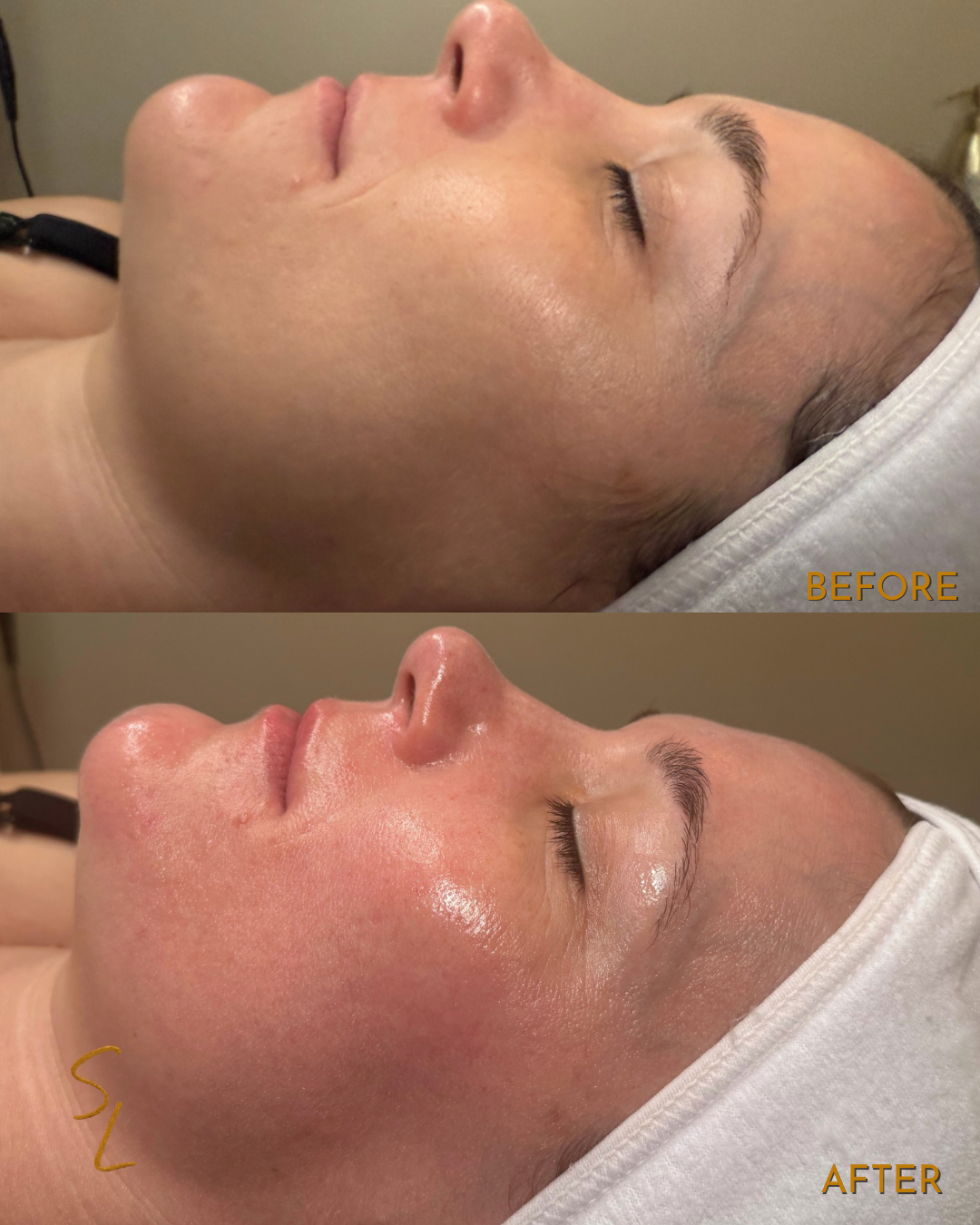 Side view of a person's face before and after a skincare treatment, showing smoother and more radiant skin in the after image.