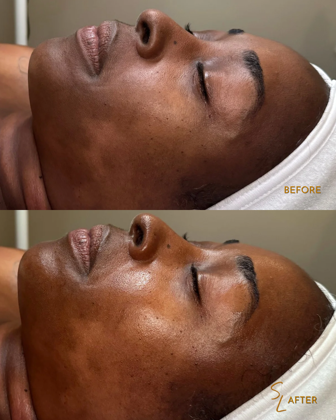 Comparison of a woman's face before and after skincare treatment, showing improved skin texture and glow in the after image.